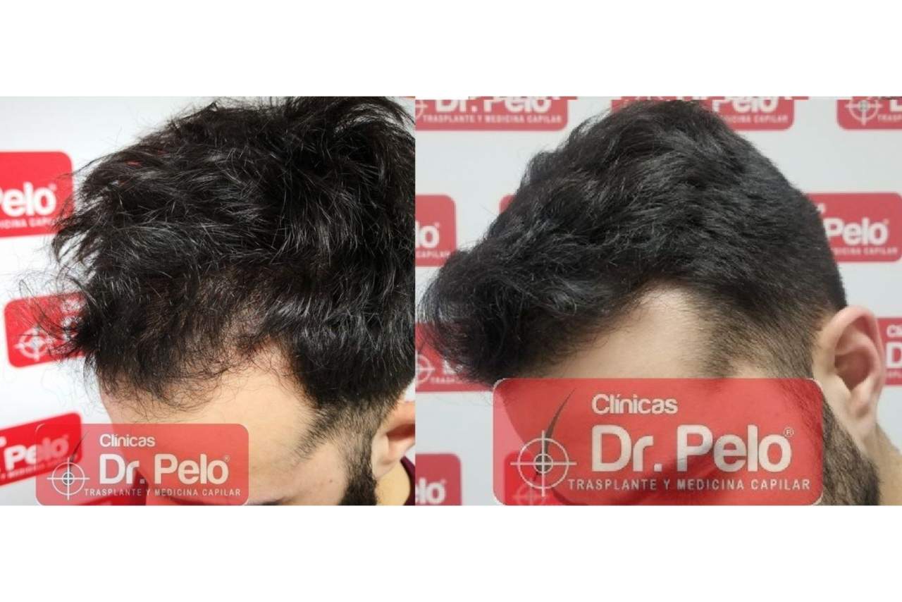 Trasplante capilar en Madrid de la mano de Clínicas Dr. Pelo