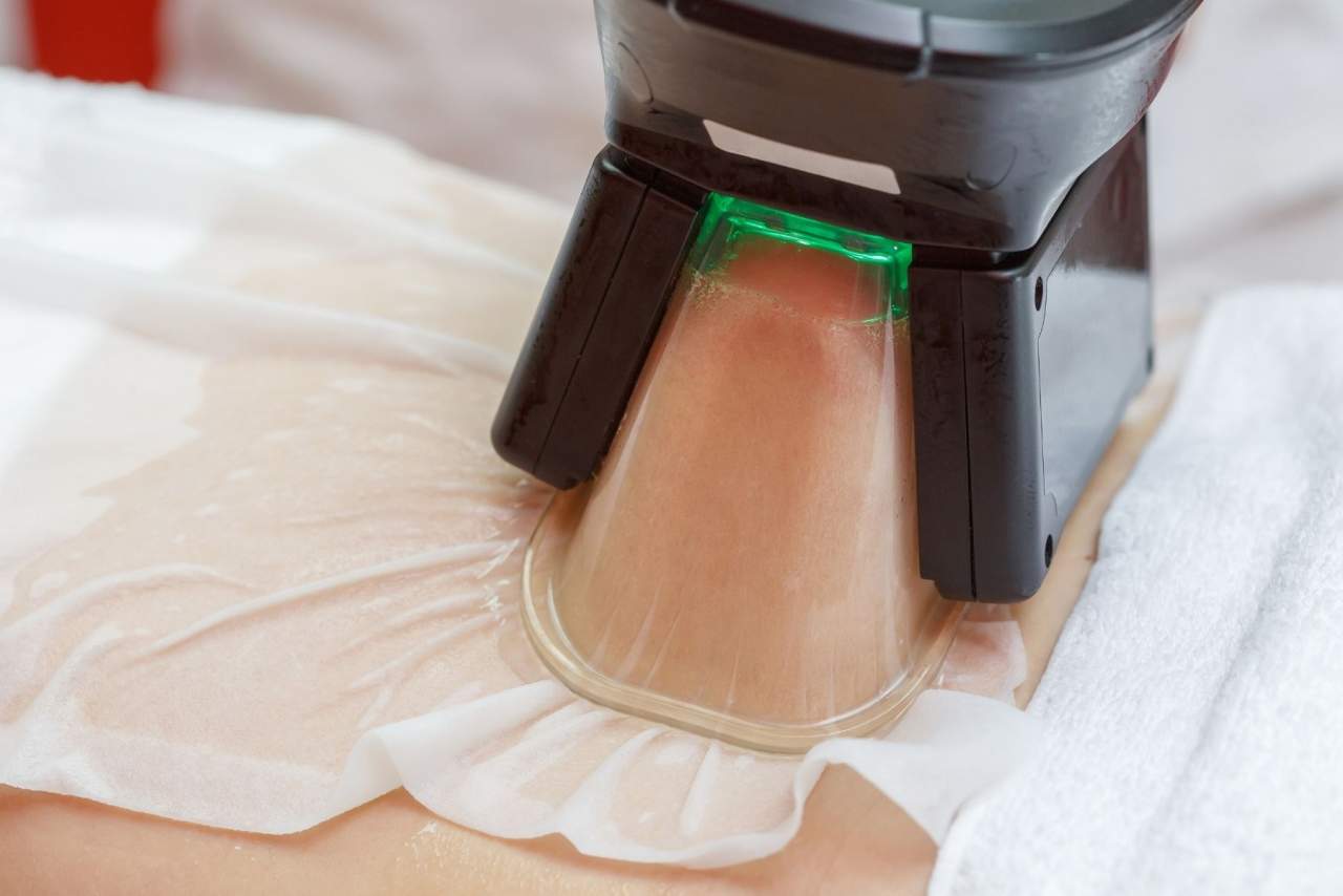 Criolipolisis médica: Eliminar grasa localizada en Santiago de Compostela con la Dra. Alfonsina Uriburu