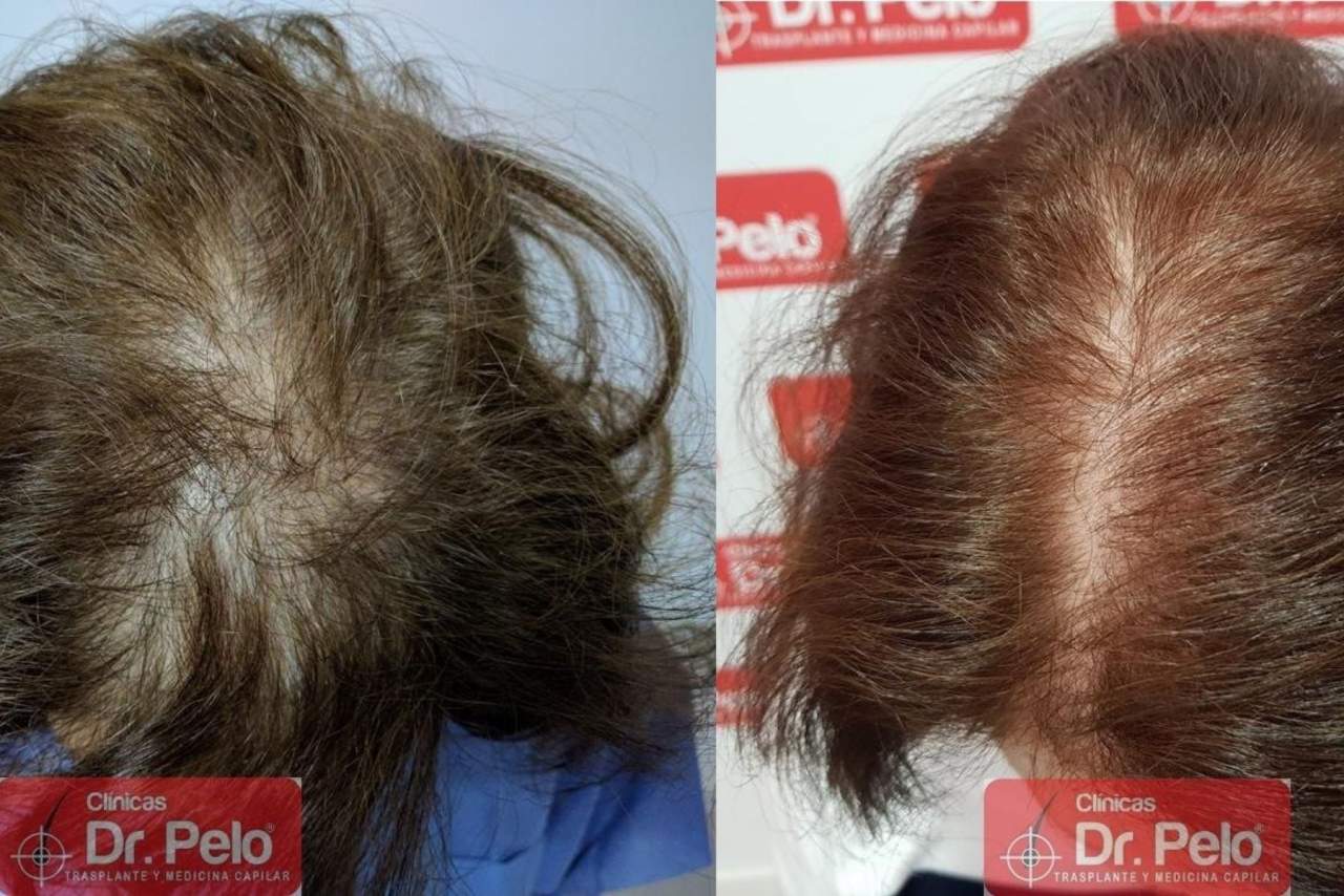 Clínica Dr. Pelo: injerto capilar en Sevilla