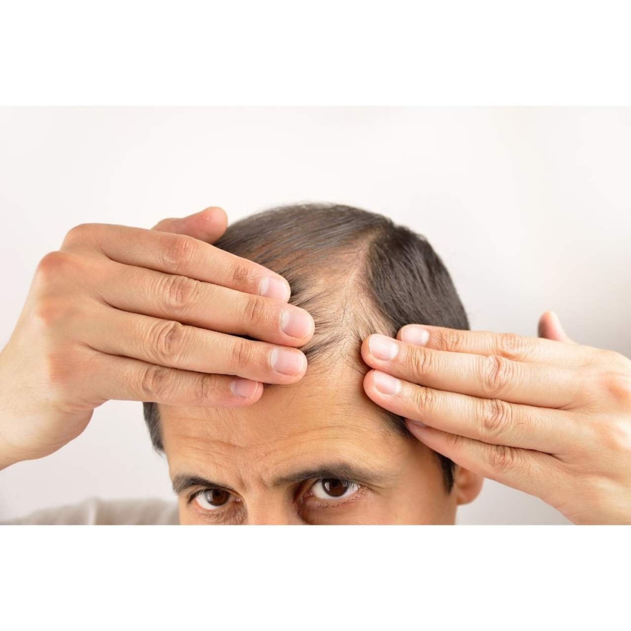 Prevenir la caída del cabello en Barcelona: Dr. Carlos Zito
