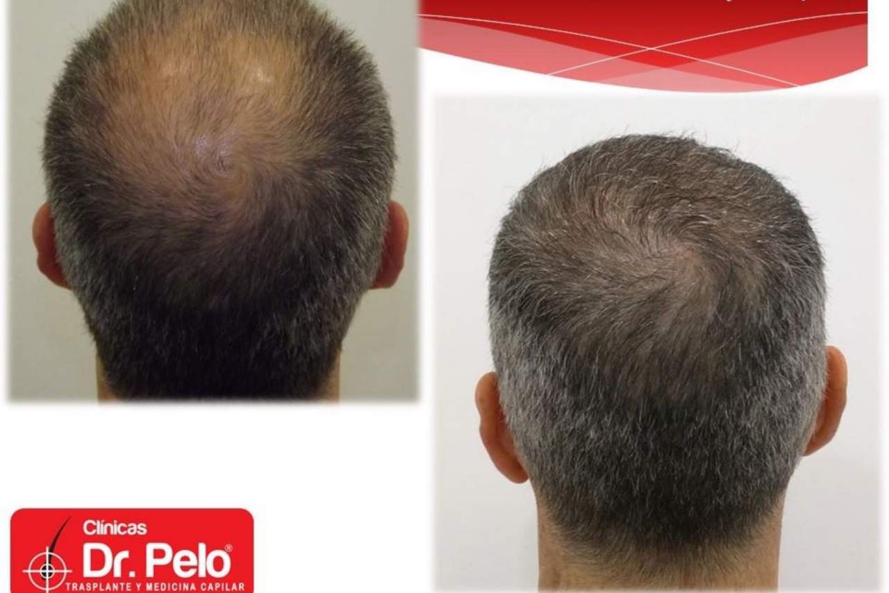 Dr. Pelo: el trasplante capilar, ¿La nueva tendencia en medicina estética?