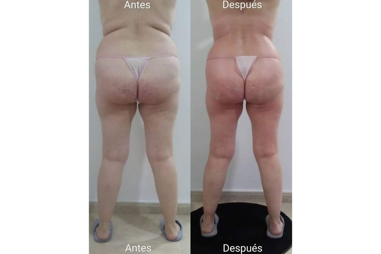 Los tratamientos reductores y anticelulíticos en el Centro de Estética Vanesa Vendrell son tendencia