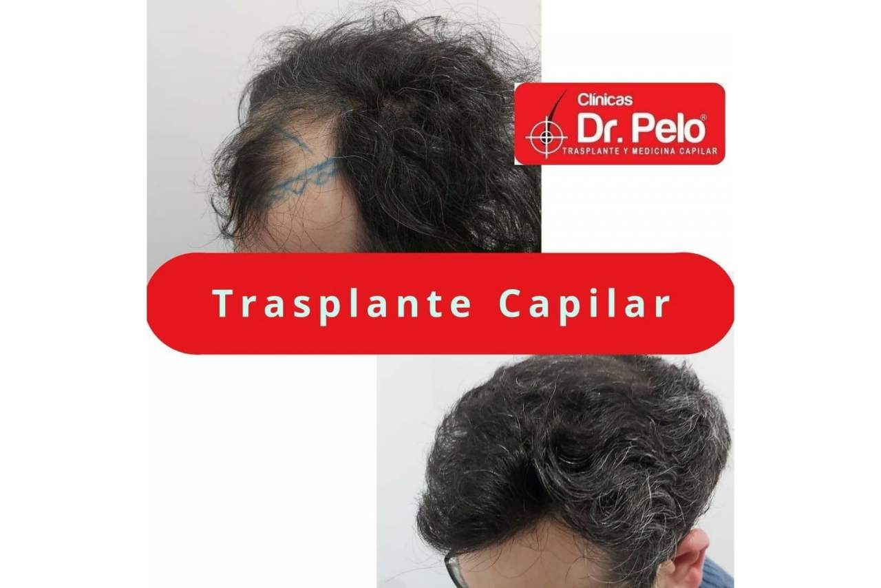 Aumento de popularidad del transplante capilar en los últimos años en España gracias a la mejora de los precios y las técnicas aplicadas
