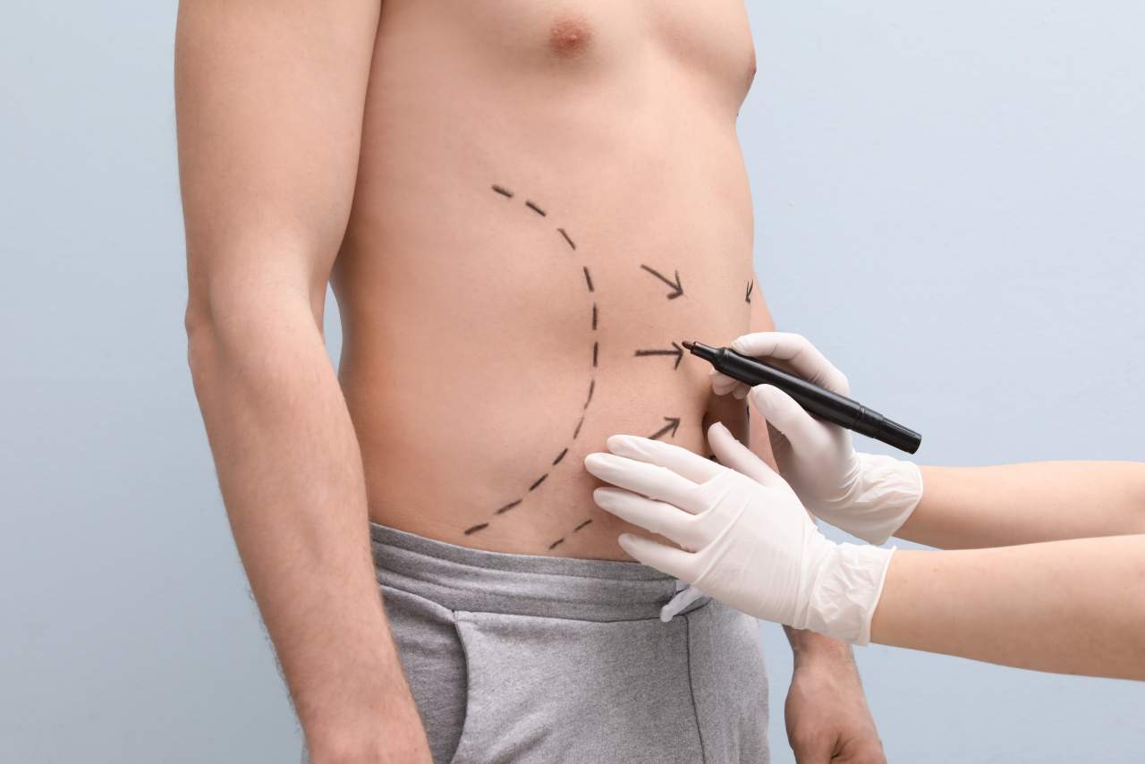 La mesoterapia corporal para eliminar la grasa localizada es el tratamiento estrella en 2021