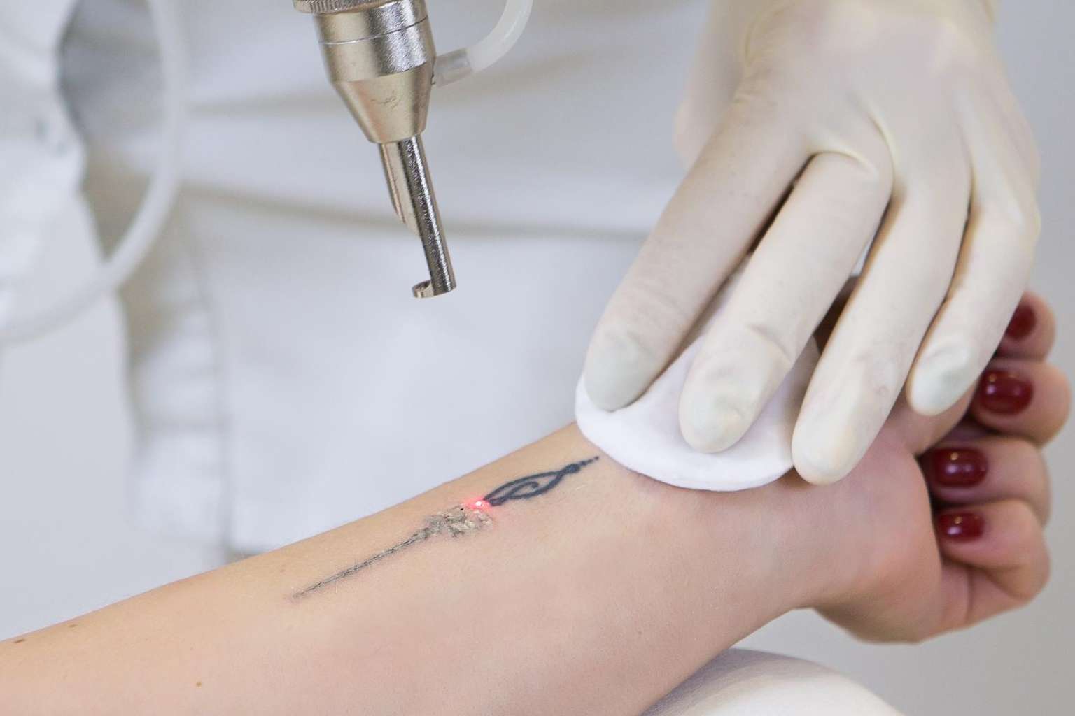 Bodyslim: Yag Láser para eliminar tatuajes