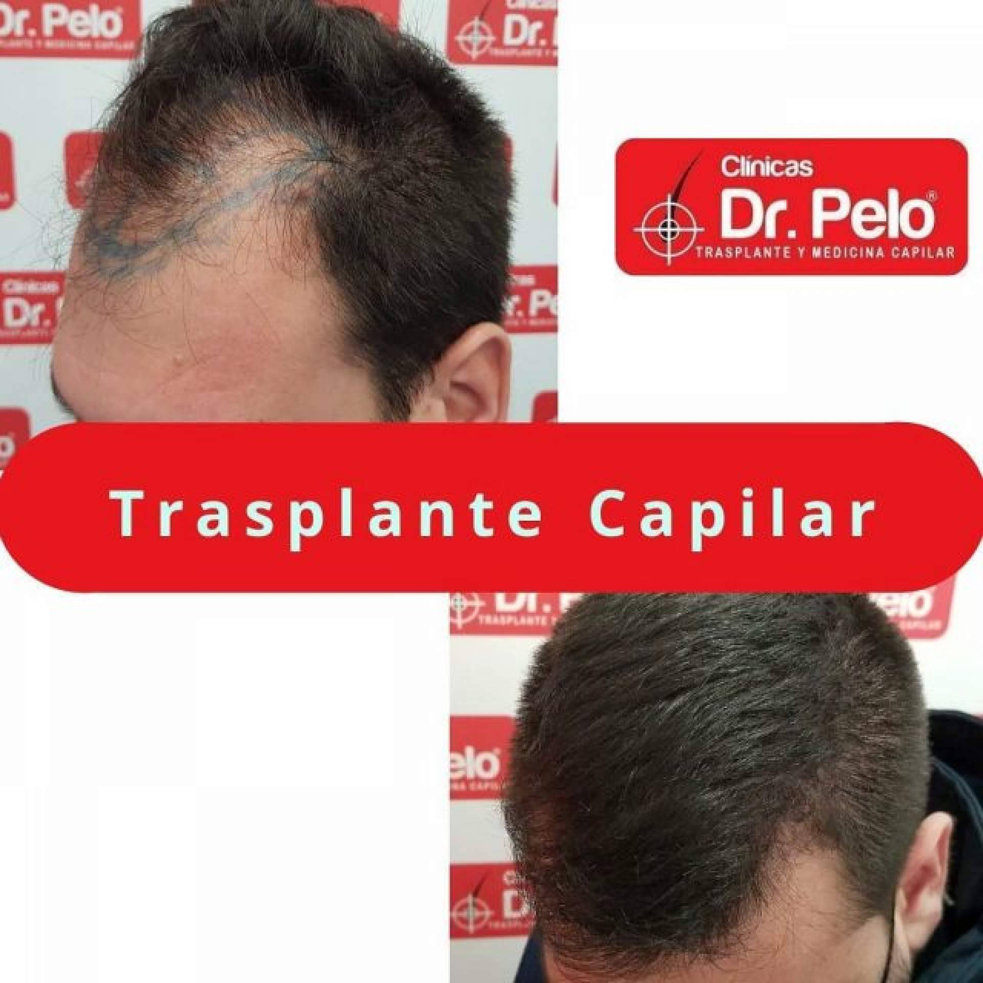 ¿Cómo frenar las entradas en el pelo gracias a las Clínicas Dr. Pelo? La importancia del trasplante capilar cuando existe una pérdida de cabello