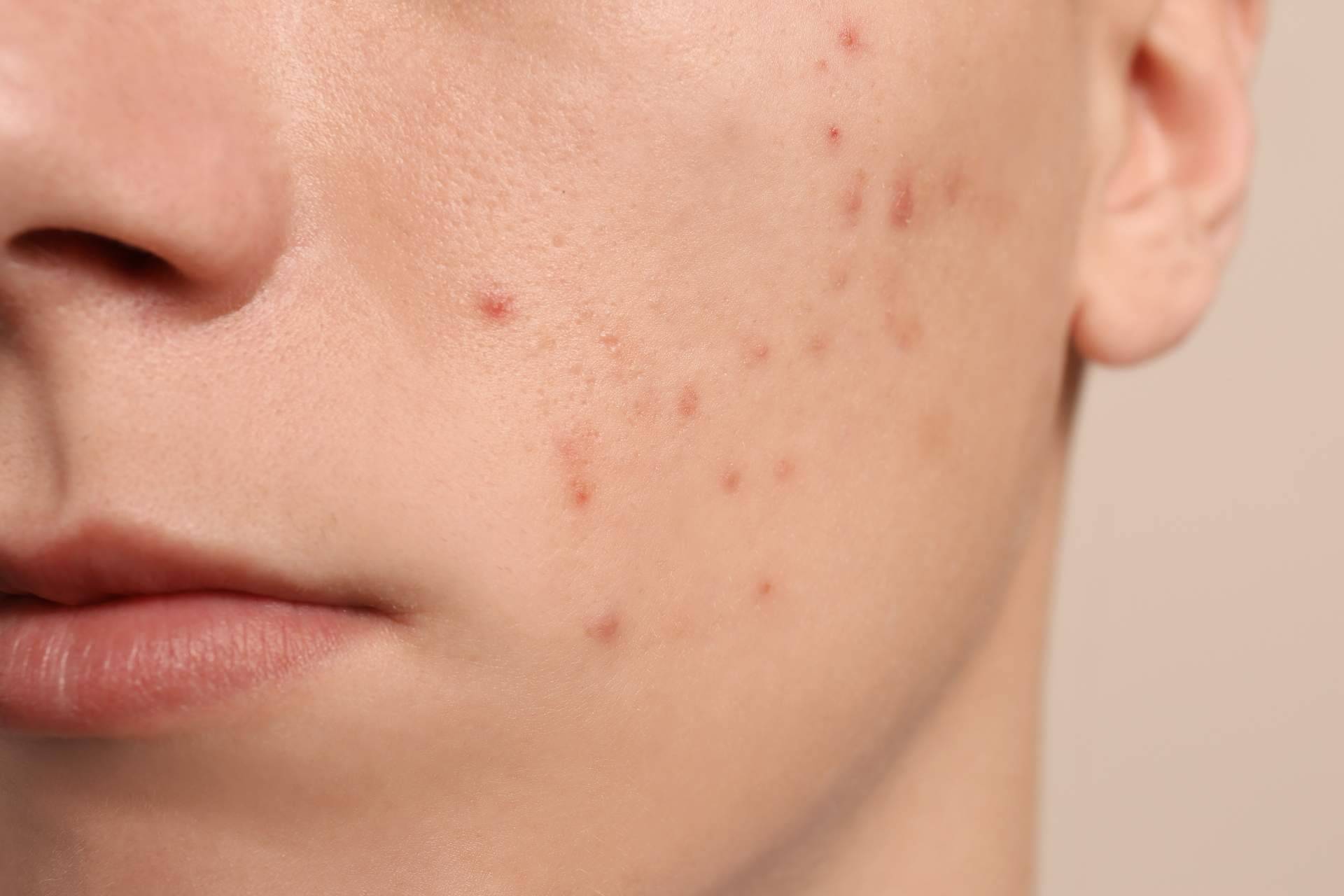 Terminar con las espinillas y el acné es posible actualmente gracias a AcnéXero, una aplicación de inteligencia artificial fundada por dos dermatólogos