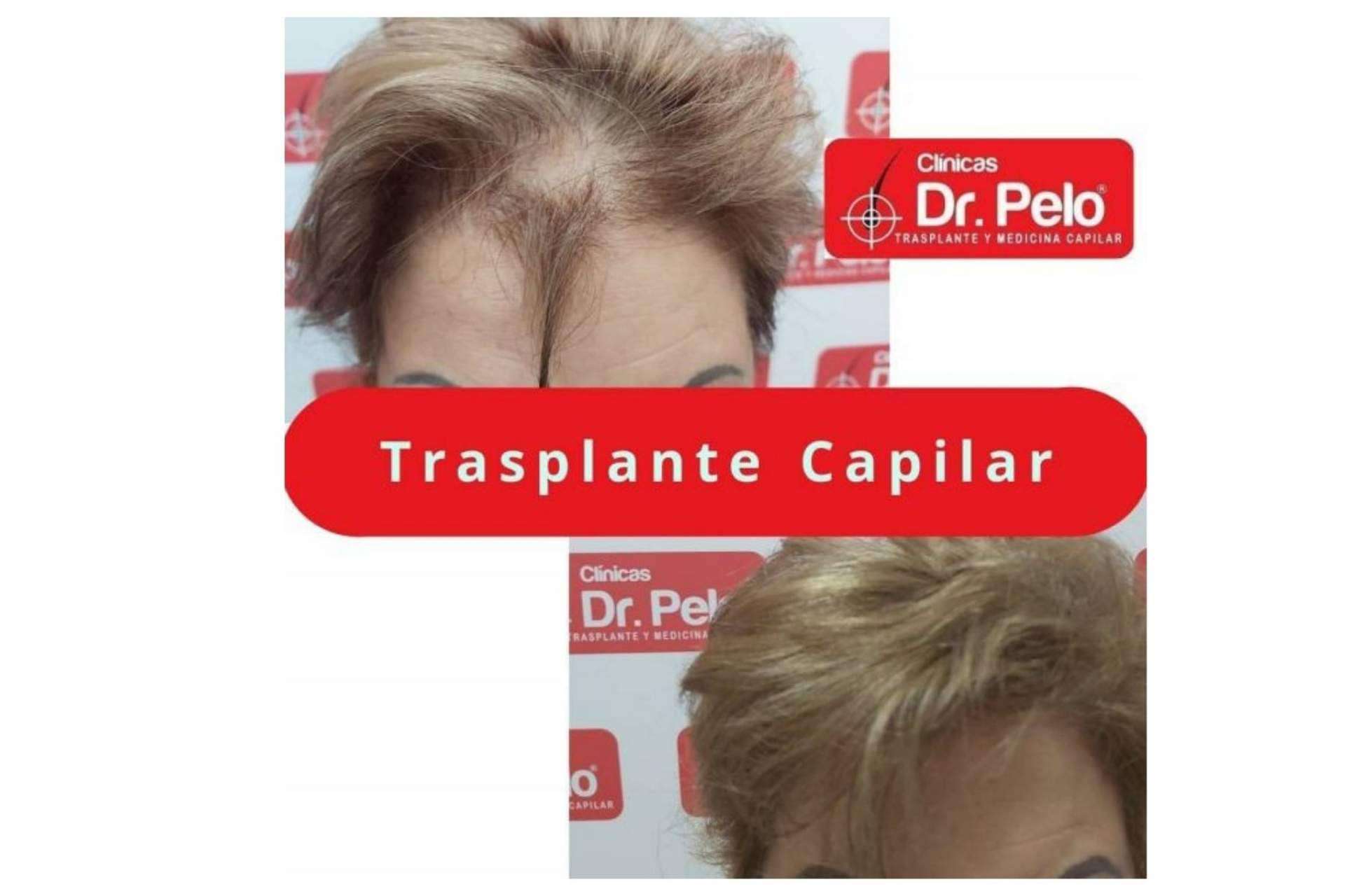 Clínica Dr.Pelo: ¿Cuál es la mejor clínica para someterse a un injerto capilar en Sevilla?