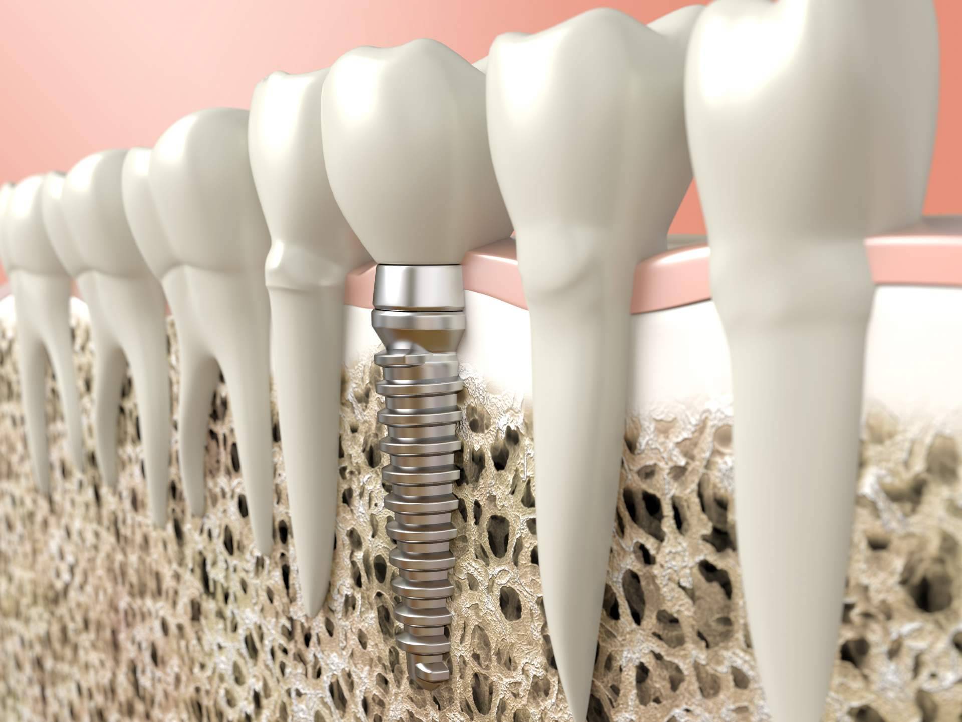 Tratamiento de implantes dentales y ortodoncia invisible en Clínica Dental Heins