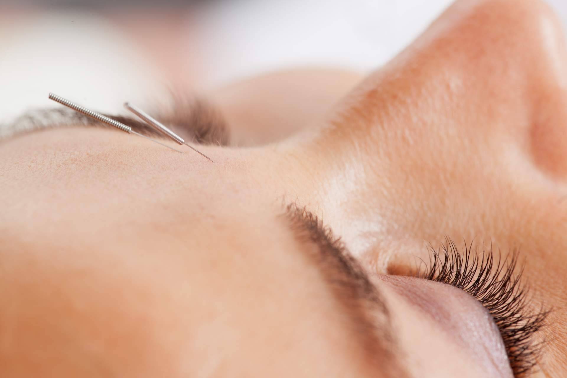 ¿En qué consiste la acupuntura estética a domicilio? Kikai