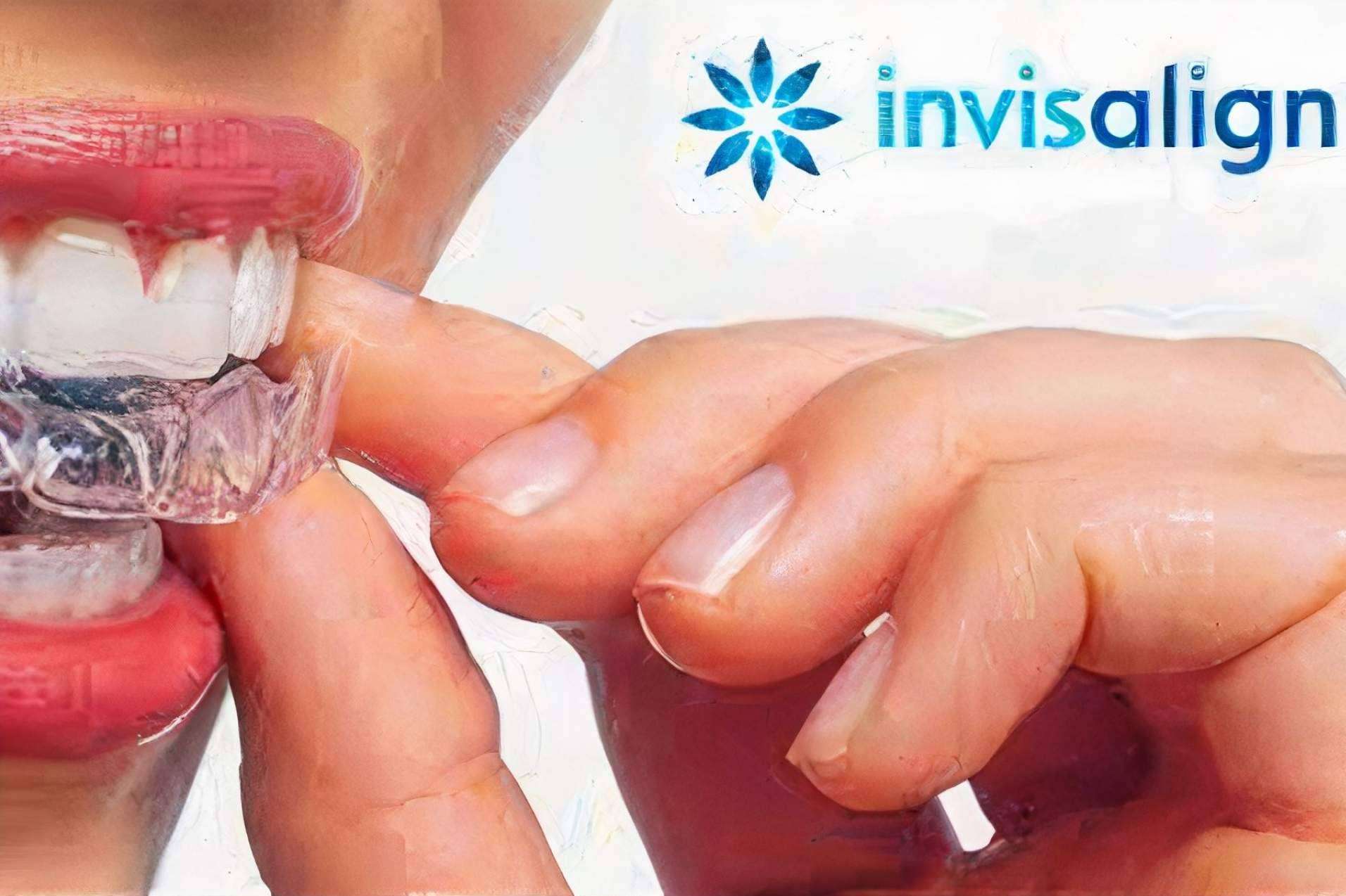 ¿Por qué la técnica Invisaling en Valencia es tan exitosa?