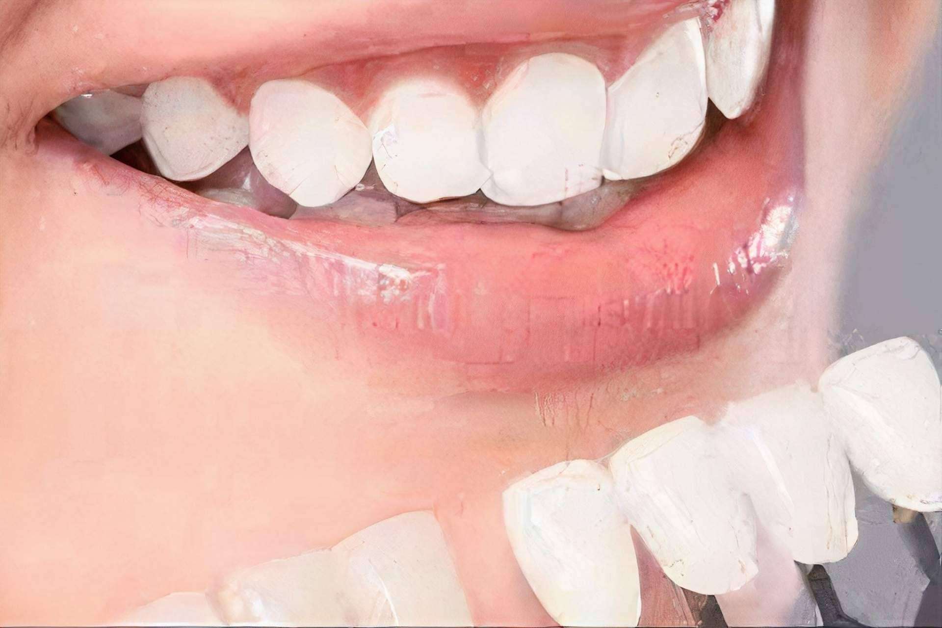 ¿Dónde realizarse un blanqueamiento dental de calidad? Implant Clinics