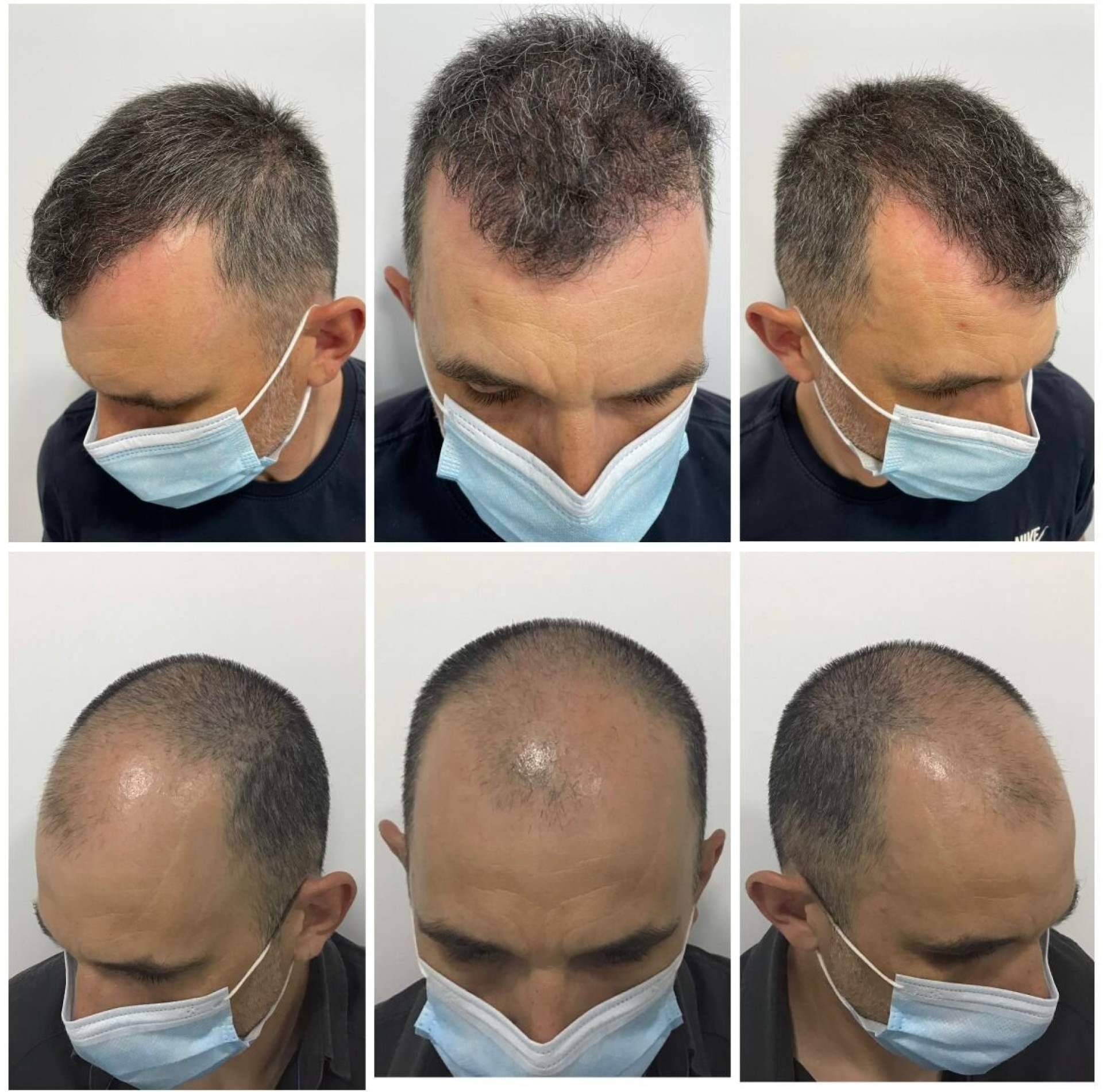 ¿Dónde realizarse el injerto capilar más natural y denso en Barcelona?: Dr. Bruno Jacobovski