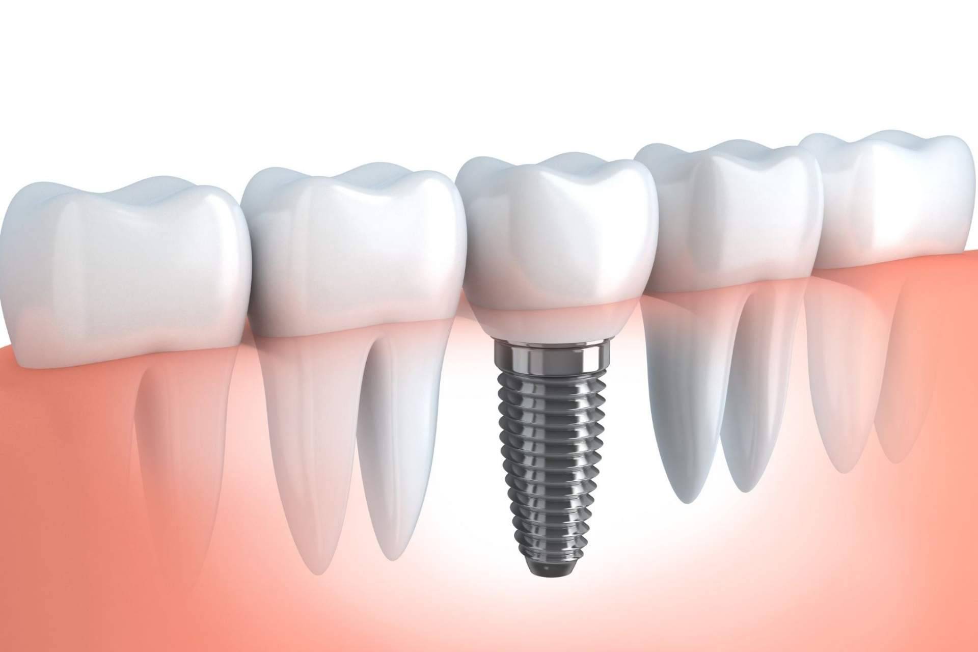 ¿Qué son los implantes de carga inmediata de Implant Clinics?