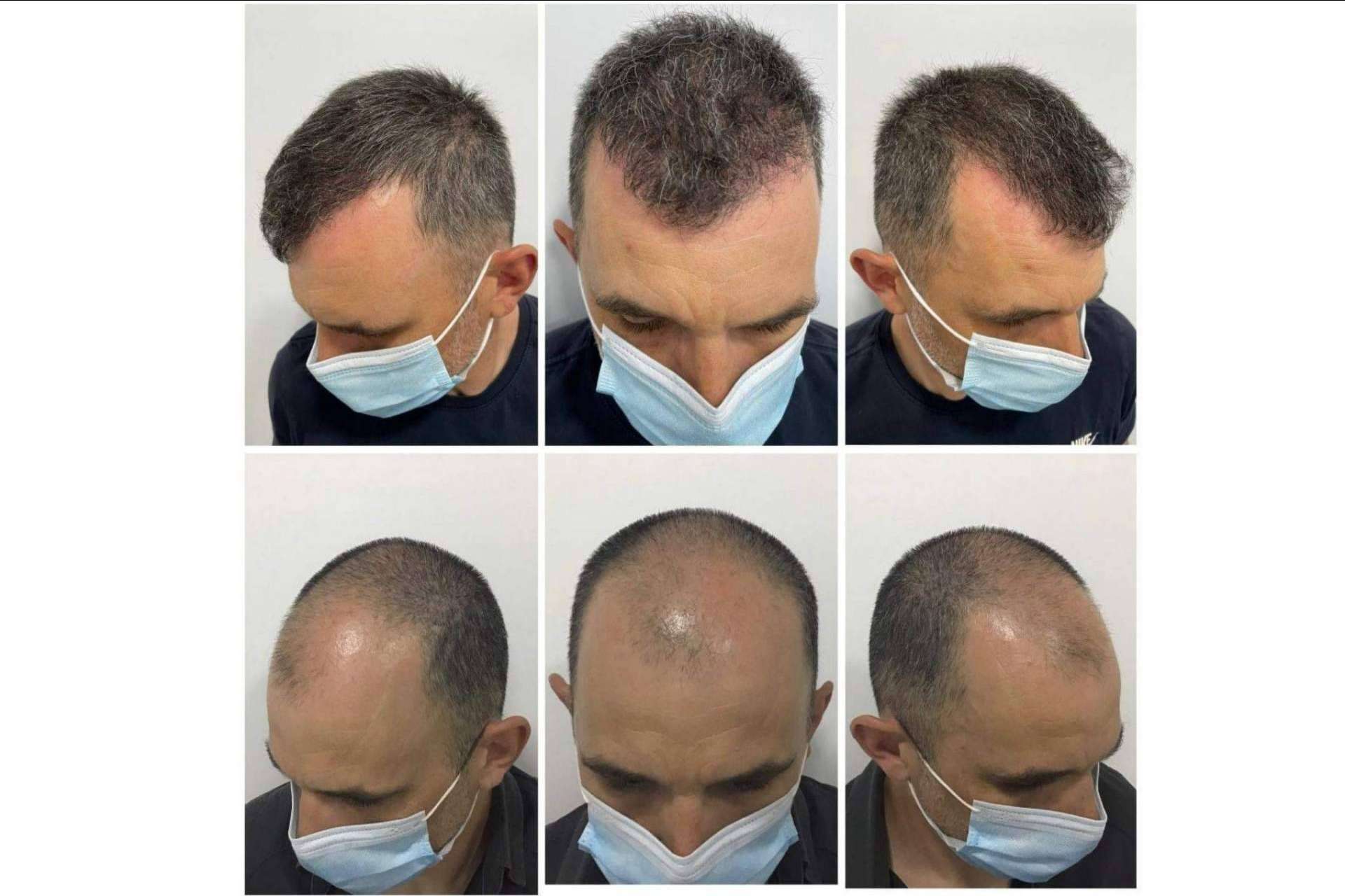 Dr. Bruno Jacobovski: ¿En qué consiste el tratamiento de mesoterapia capilar?