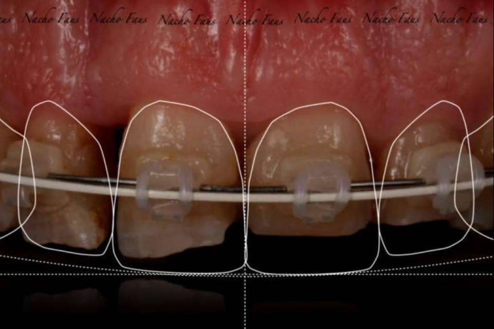 Las técnicas avanzadas en implantología de Clínica Blay Monzó: expertos en odontología digital