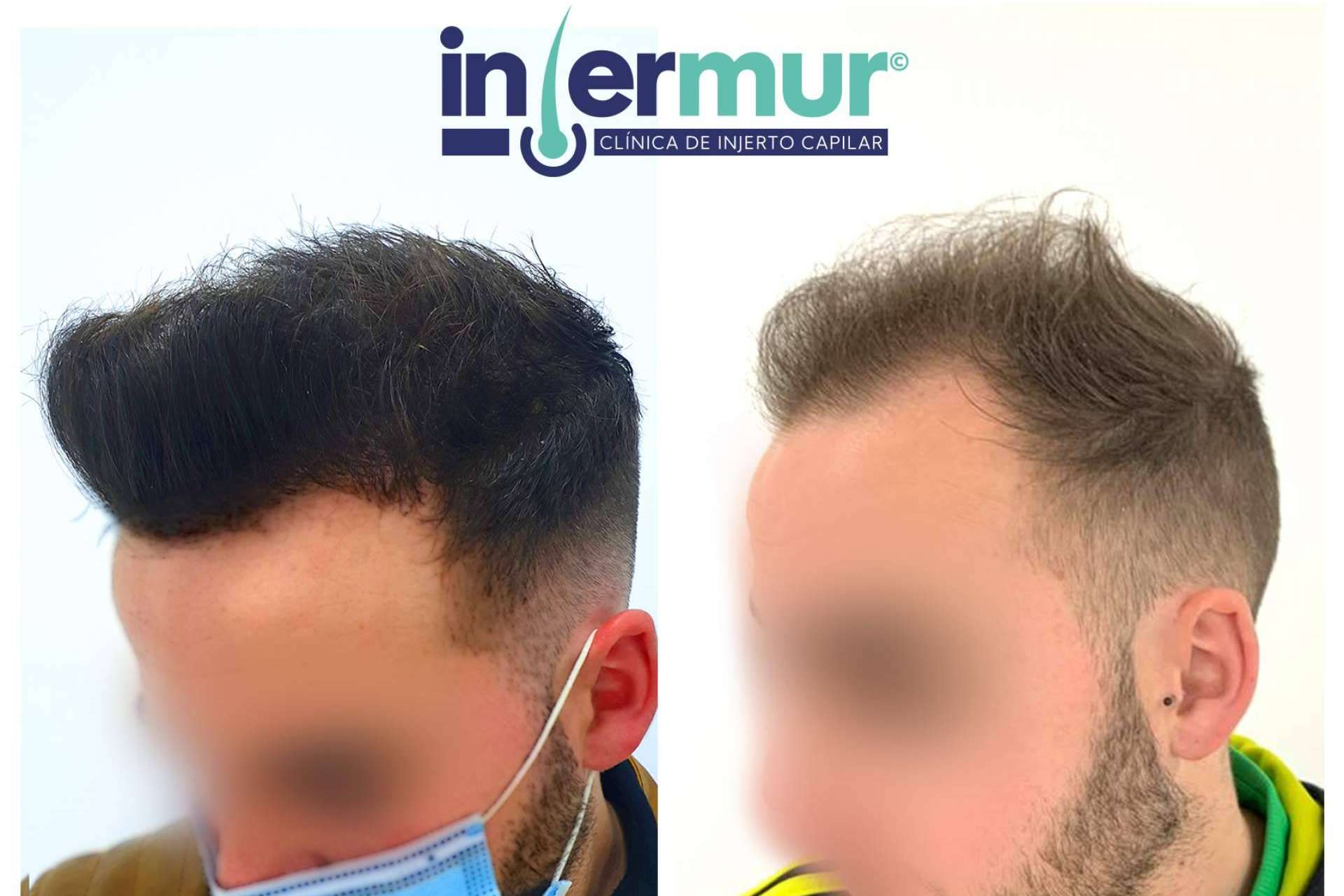 Técnica de injerto capilar sin cicatriz en la clínica Injermur