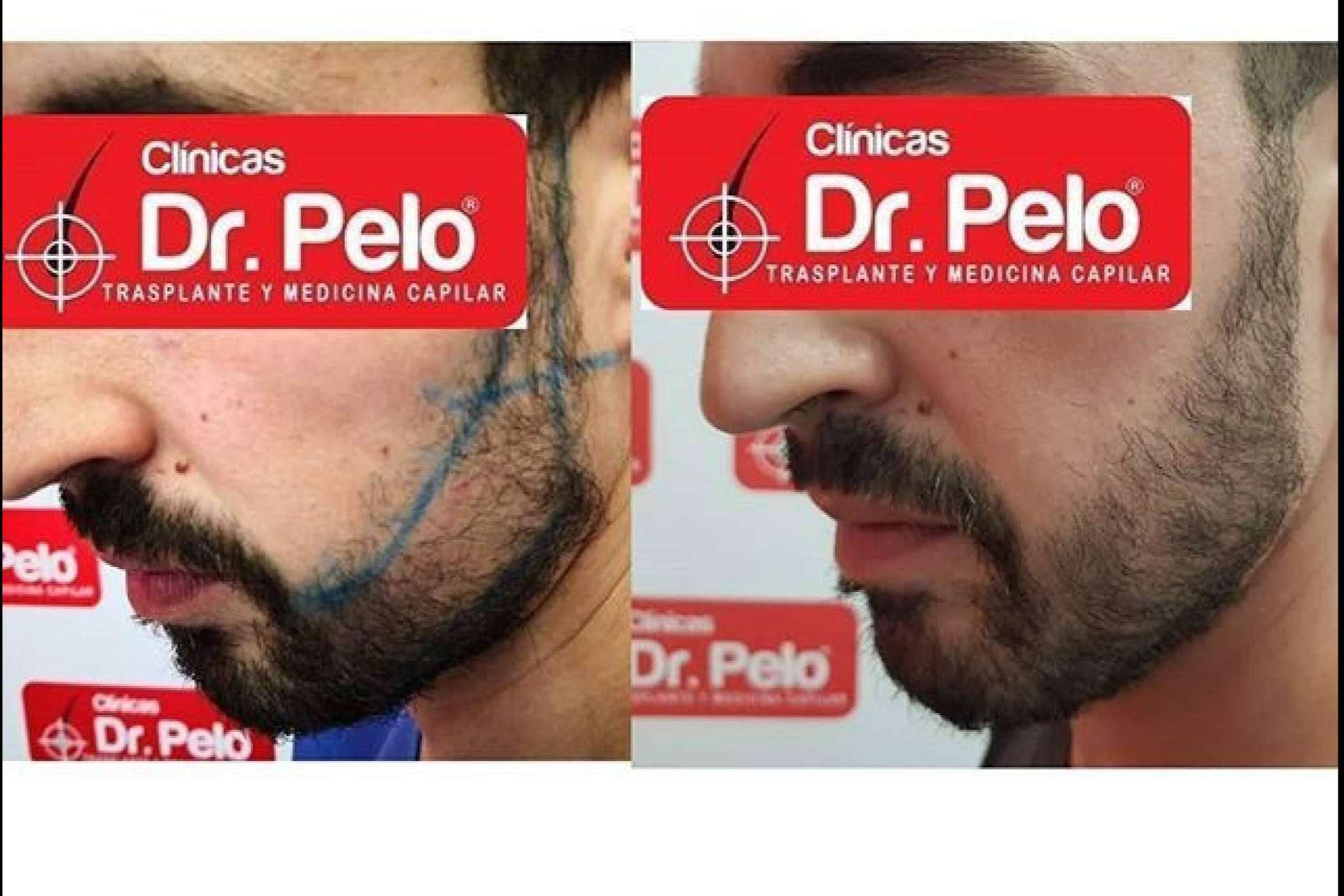 El trasplante de barba de Clínicas Dr. Pelo, uno de los tratamientos con resultados más satisfactorios