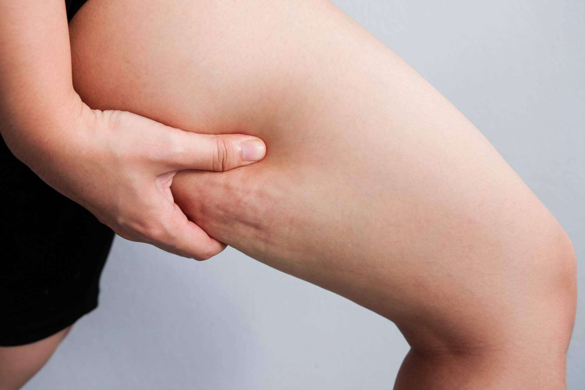 Combatir la celulitis de una forma natural con Sincelut Forte
