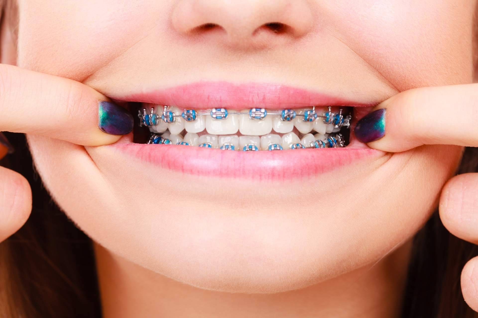 Ortodoncia de máxima calidad en Badajoz con los expertos de Clínica Sonrisas de Corrales Dental