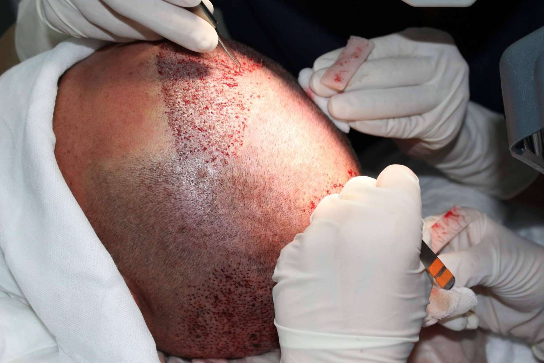 Las ventajas de recurrir a Injerto Capilar en Murcia