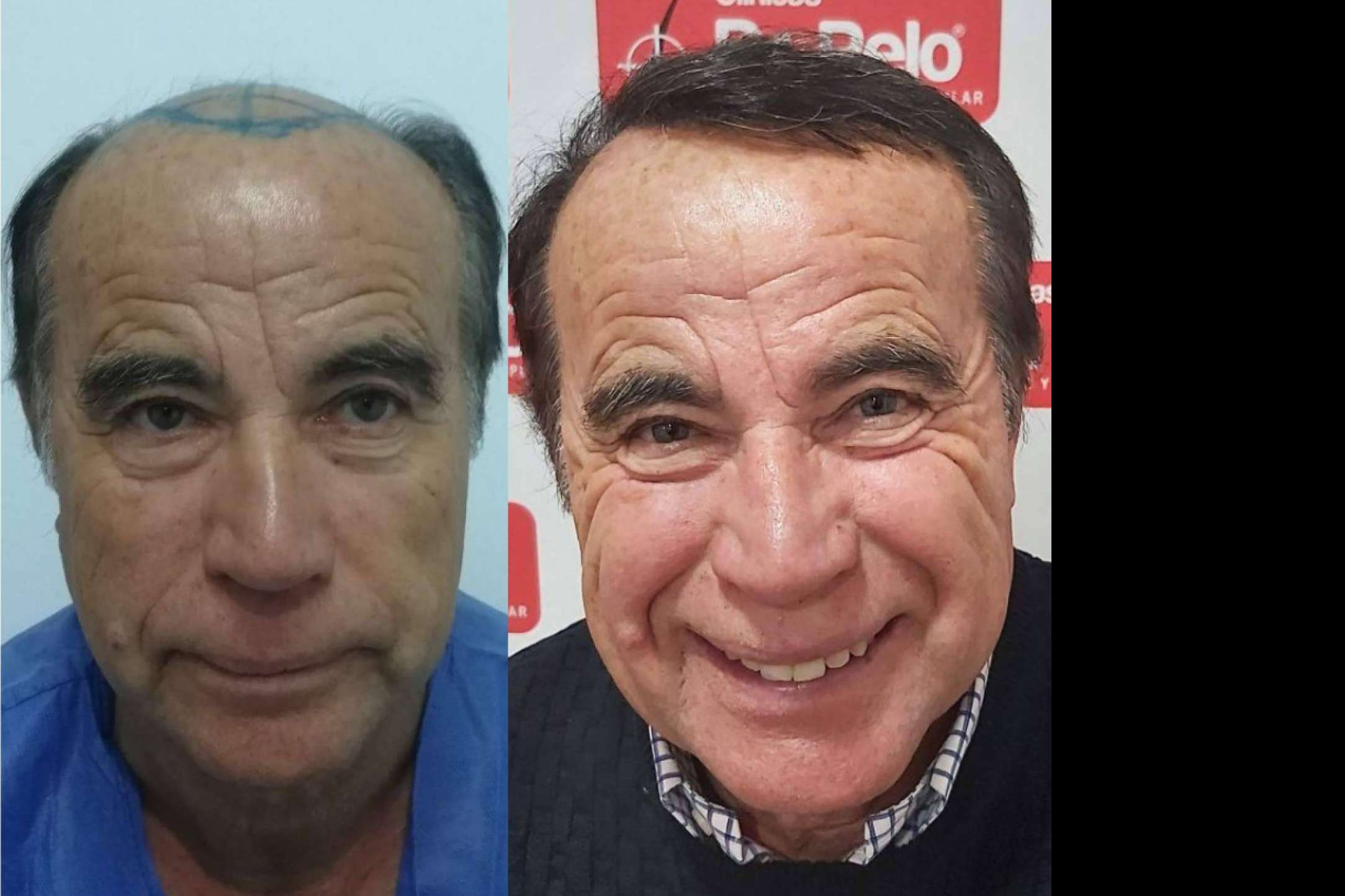 Trasplantes capilares con efecto natural realizados por Clínicas Dr. Pelo