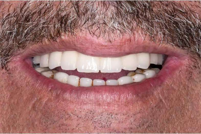 Rehabilitaciones orales complejas en un día en la clínica dental Bordonclinic