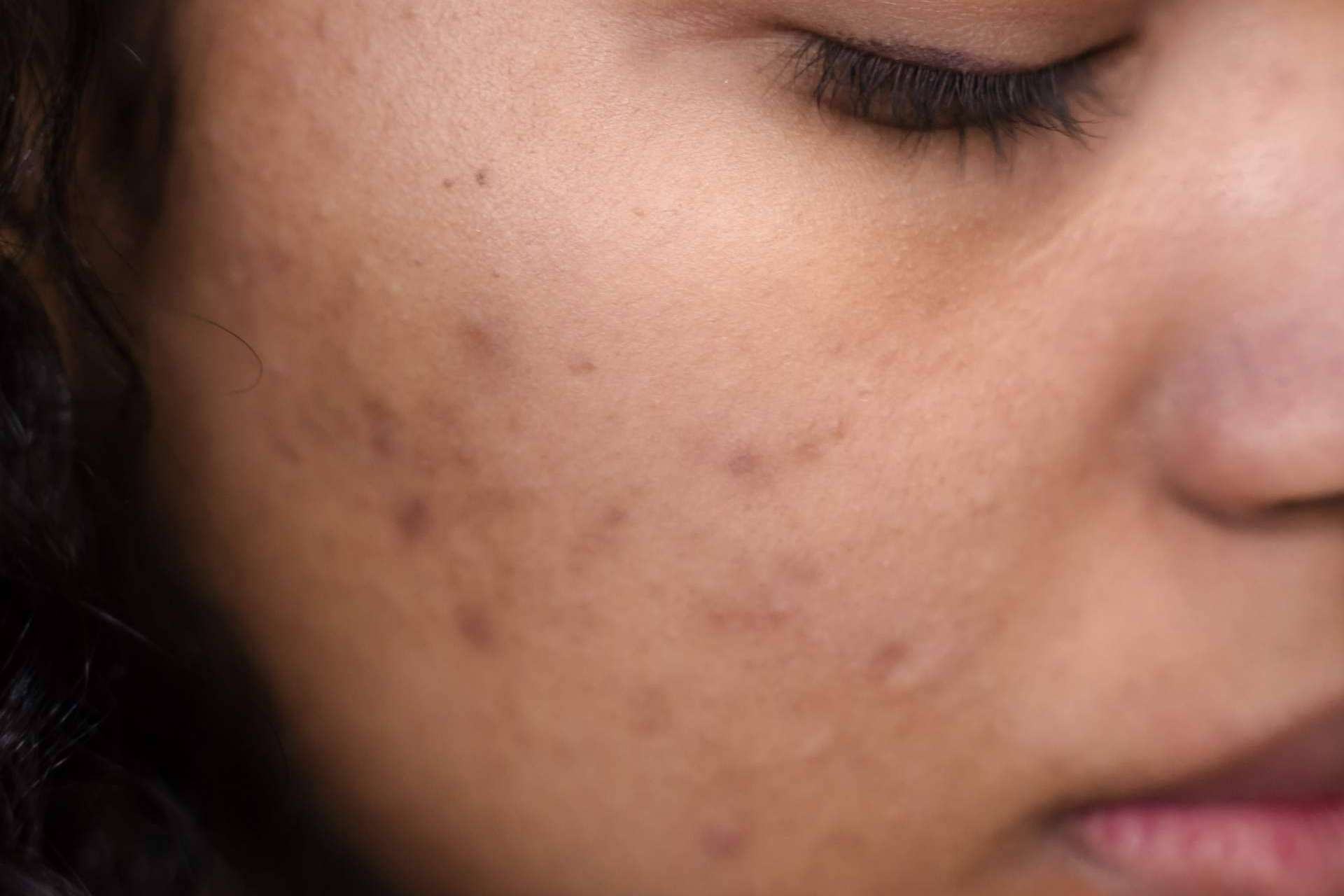 Bėyo Beauty dispone de un tratamiento contra el acné que brinda muchos beneficios