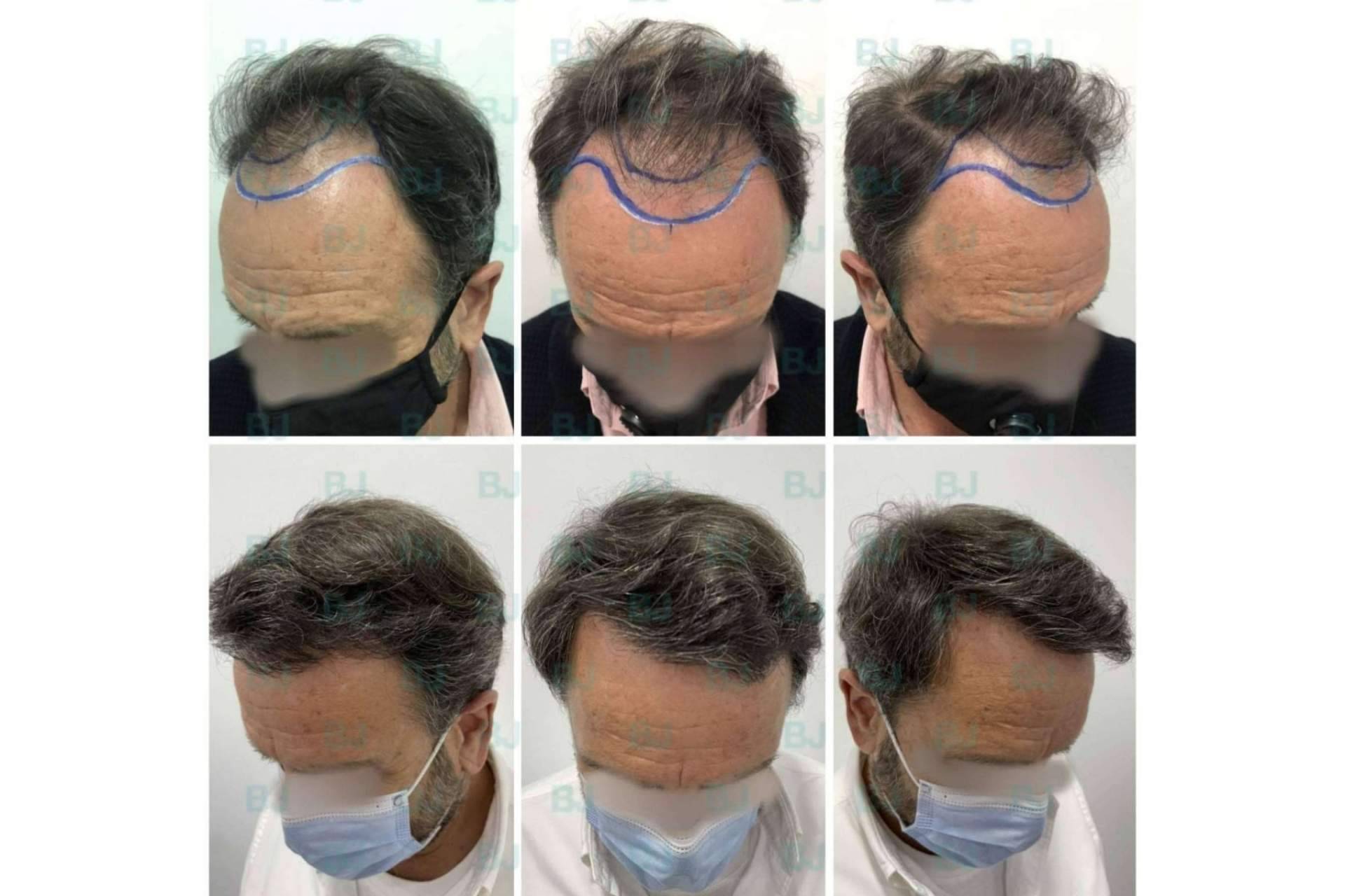 Acerca de las diferencias de las técnicas de implante capilar FUSS y FUE, en la clínica capilar de Dr. Bruno Jacobovski