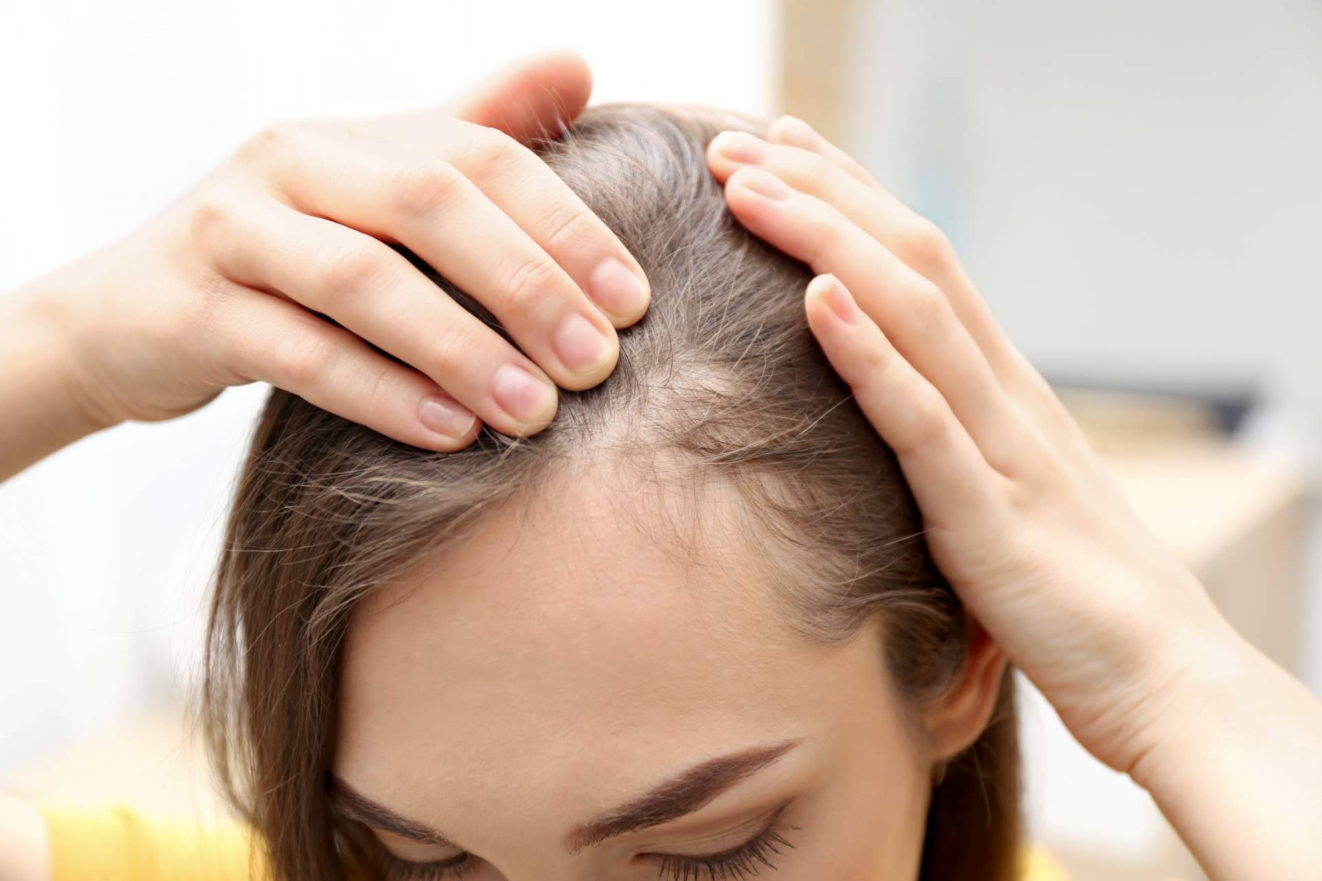 Combatir la alopecia con injertos capilares efectivos de la mano de Élite Capilar