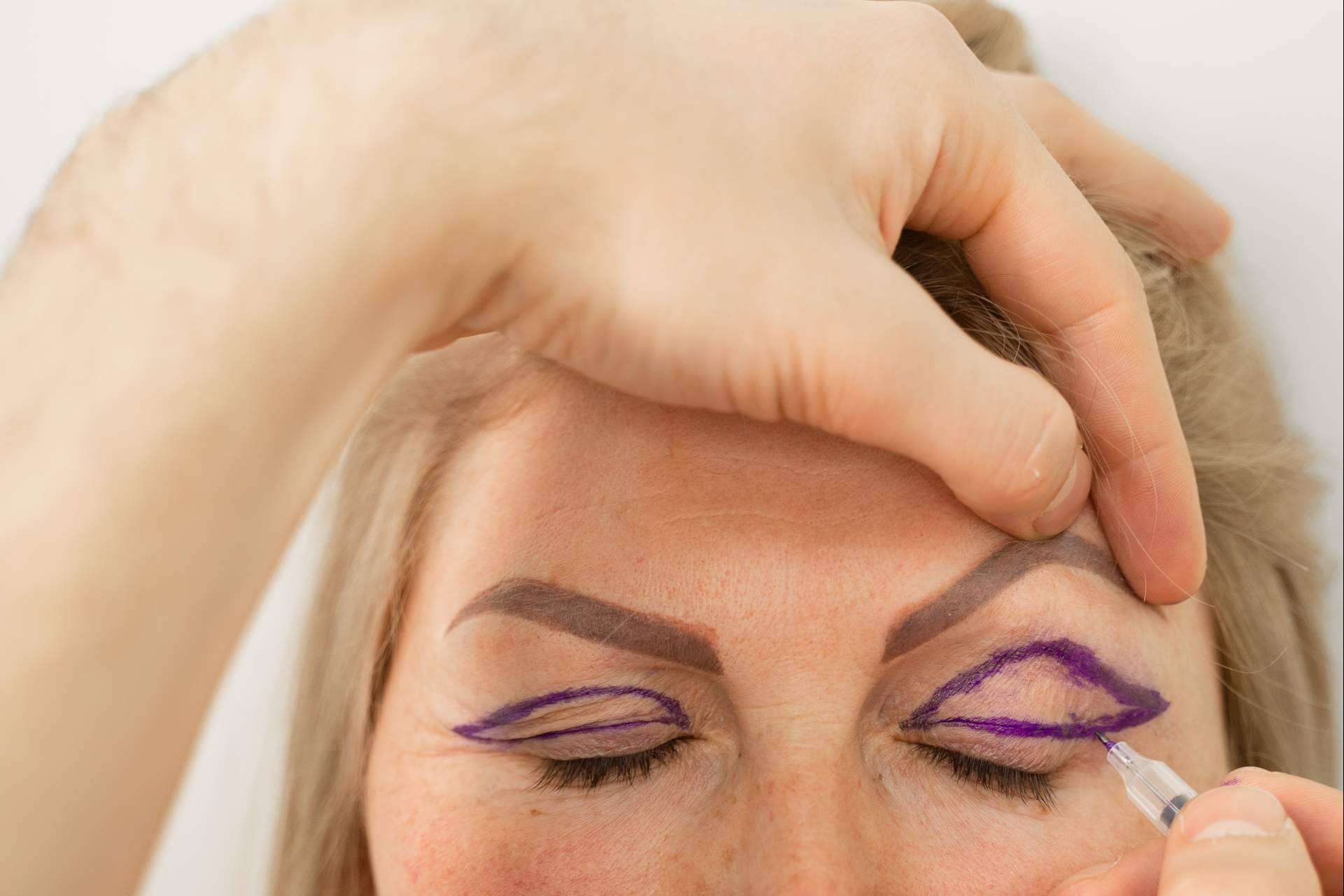 El plasma láser de Alluring Clinic para la blefaroplastia sin cirugía