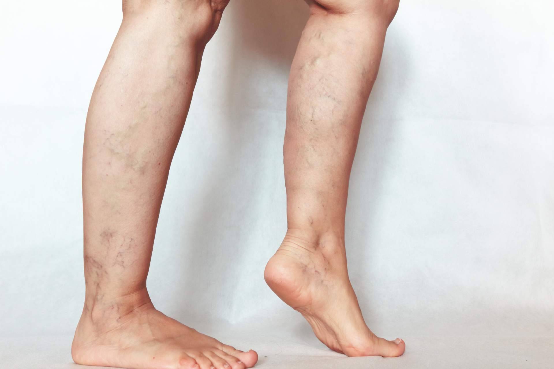¿Cómo ayuda la fisioterapia a mejorar los síntomas de las patologías del sistema vascular periférico?
