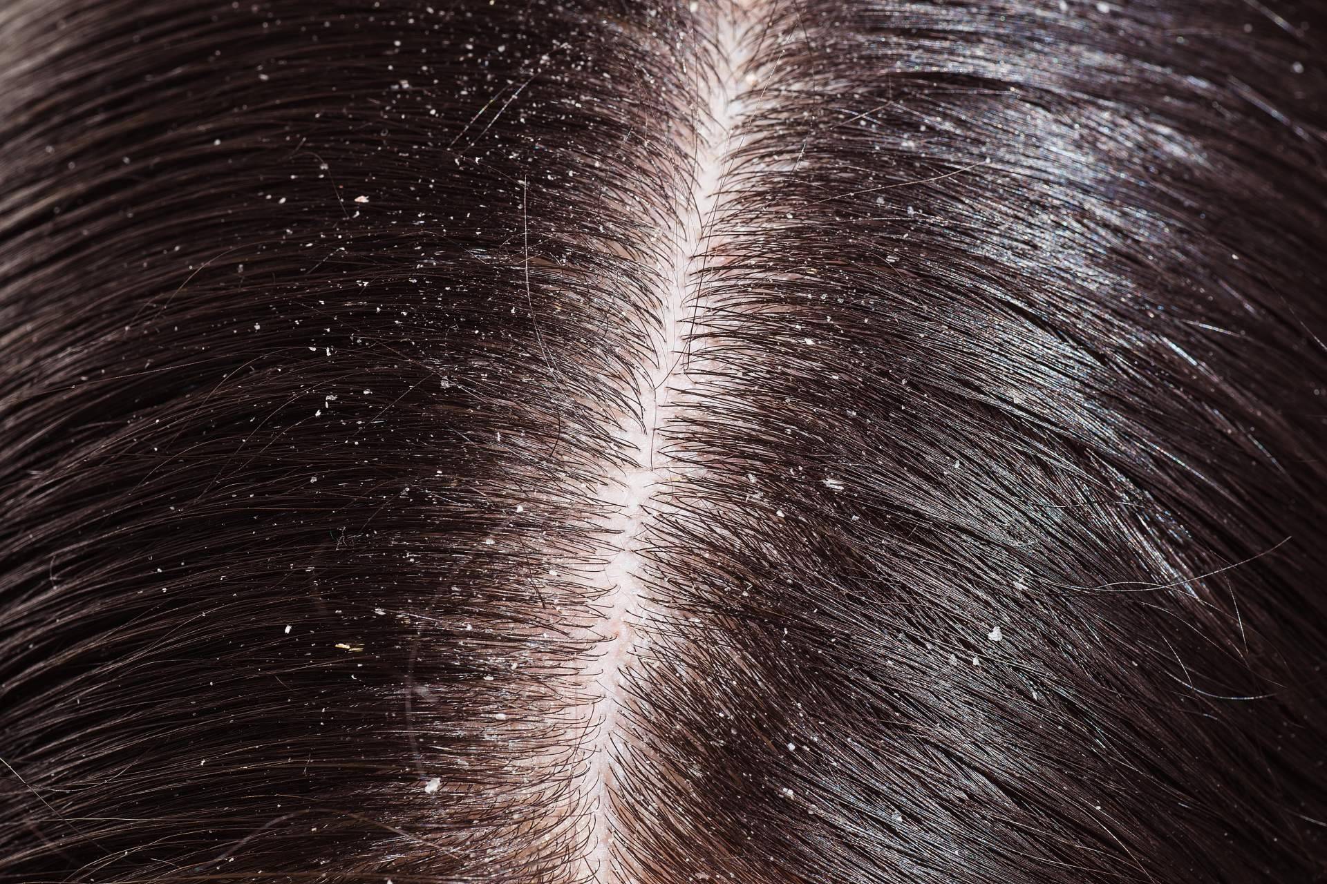 El champú especial para calmar la seborrea
