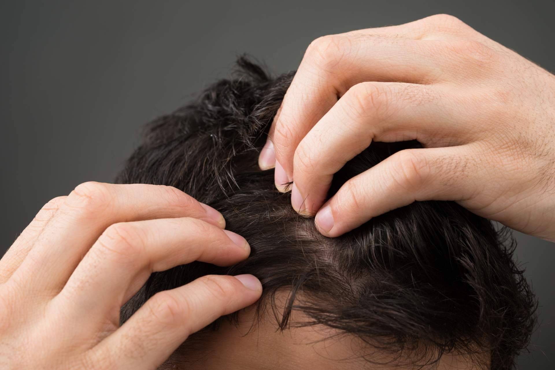 ¿Qué tipos de caídas del pelo existen?, por el Laboratorio Géomer