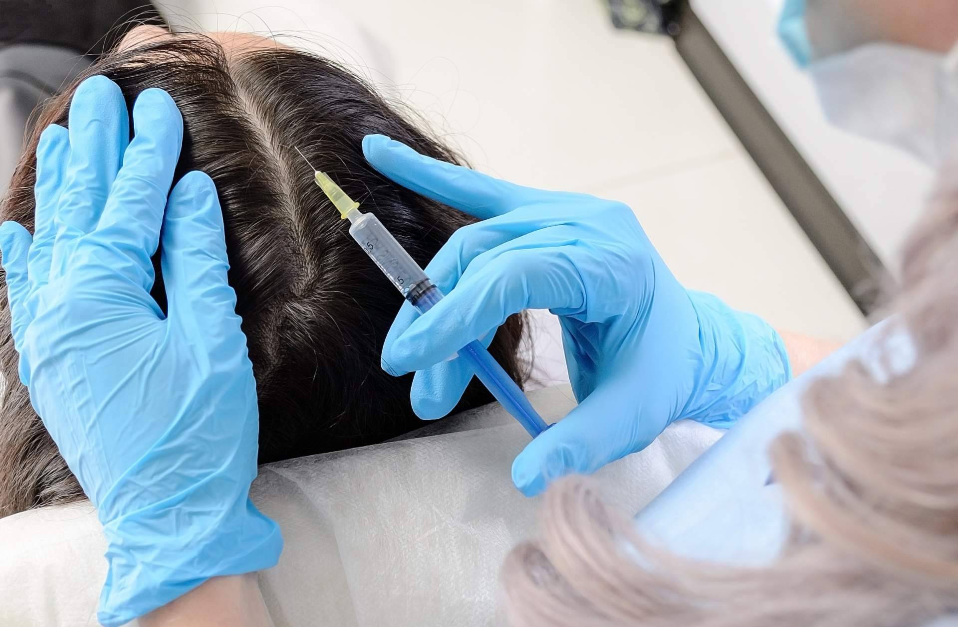 Vitaminas, mesoterapia capilar y plasma rico en plaquetas