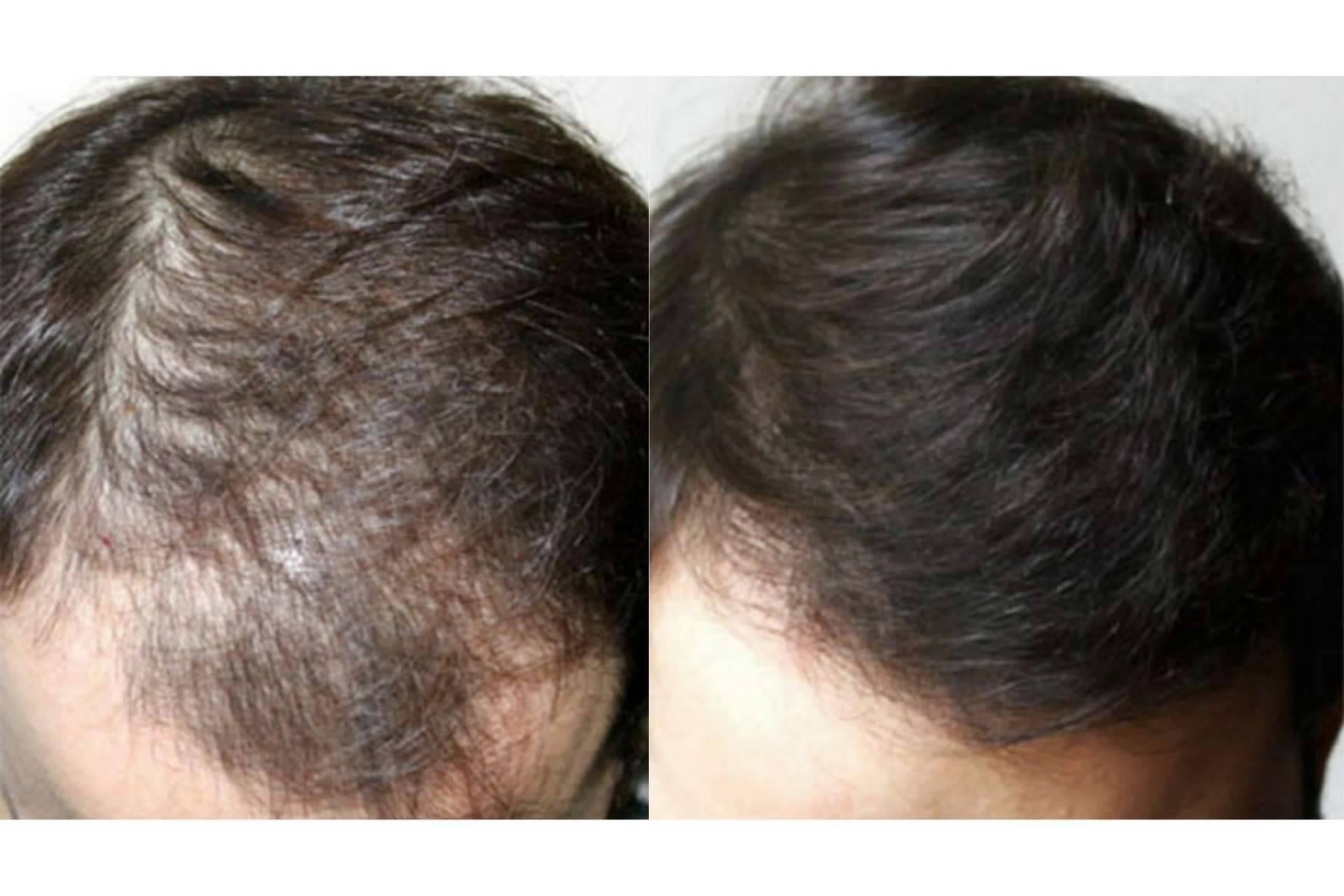 Tratamientos efectivos para alopecia androgenética en Innovación Capilar