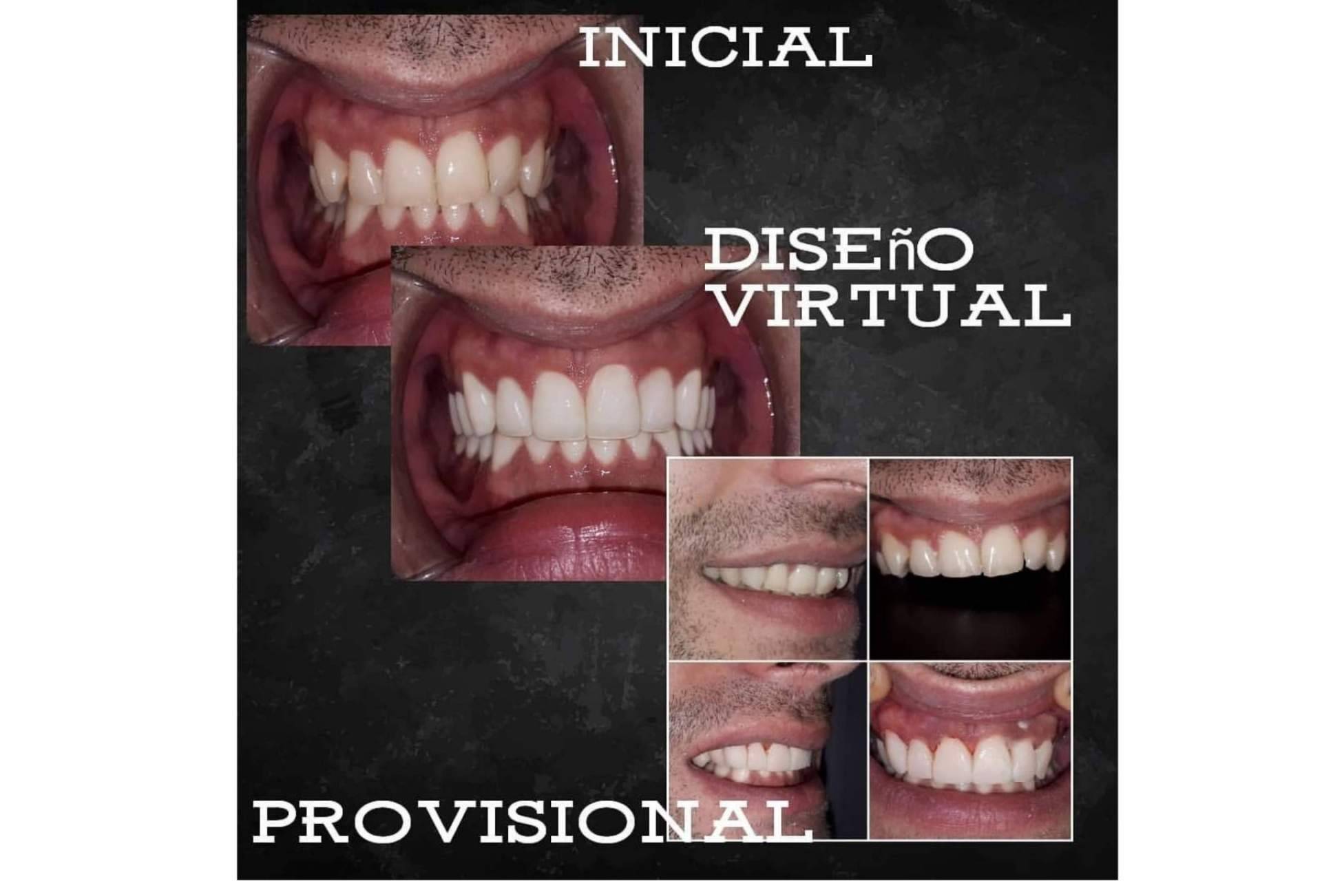 Alineación dentaria sin ortodoncia, por Dentinova