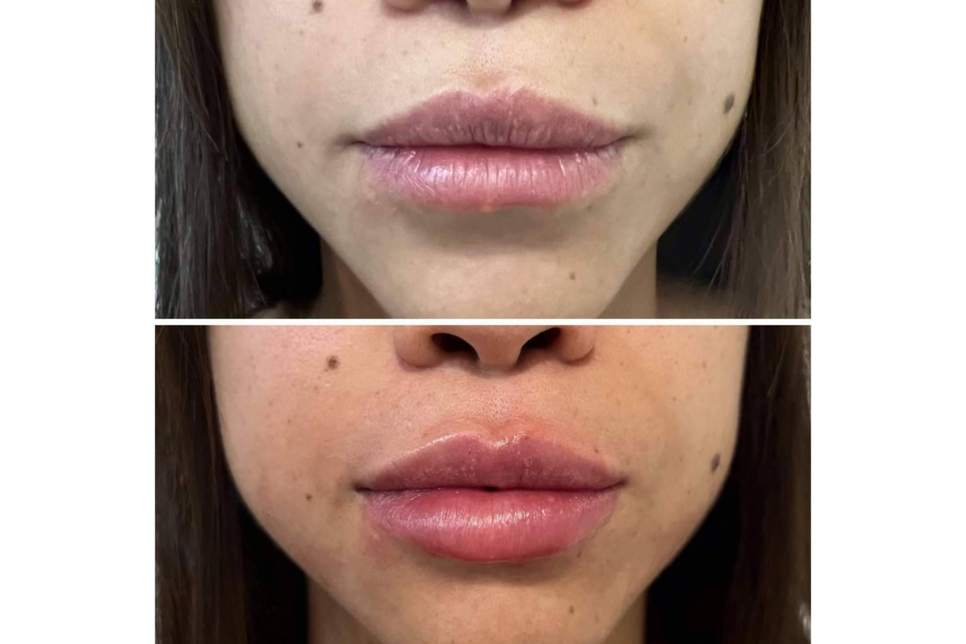 ¿Se puede conseguir un aumento de labios en Madrid con resultados naturales?, por la Dra. Cecilia Arthur