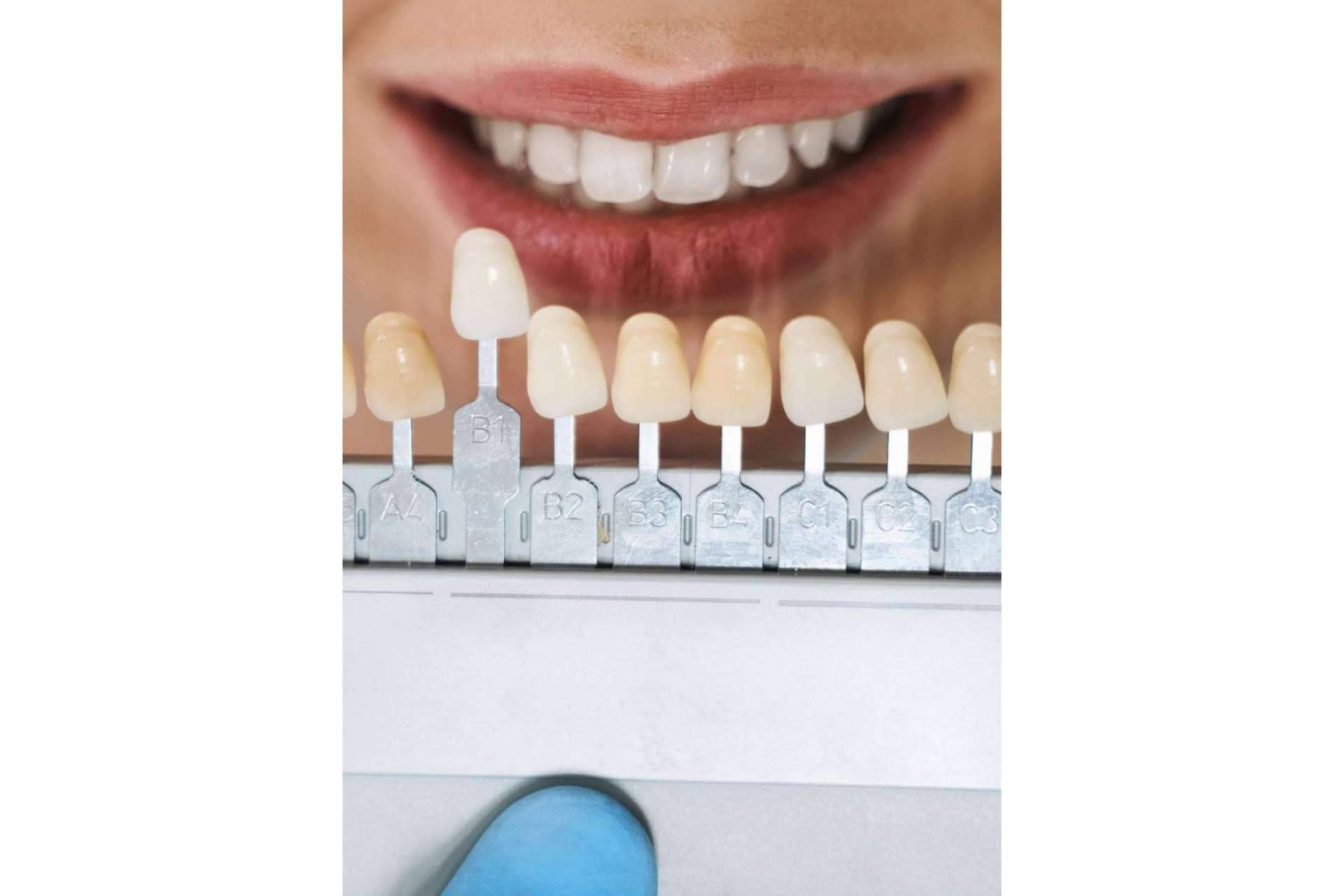 Las carillas dentales, el tratamiento estético dental por excelencia