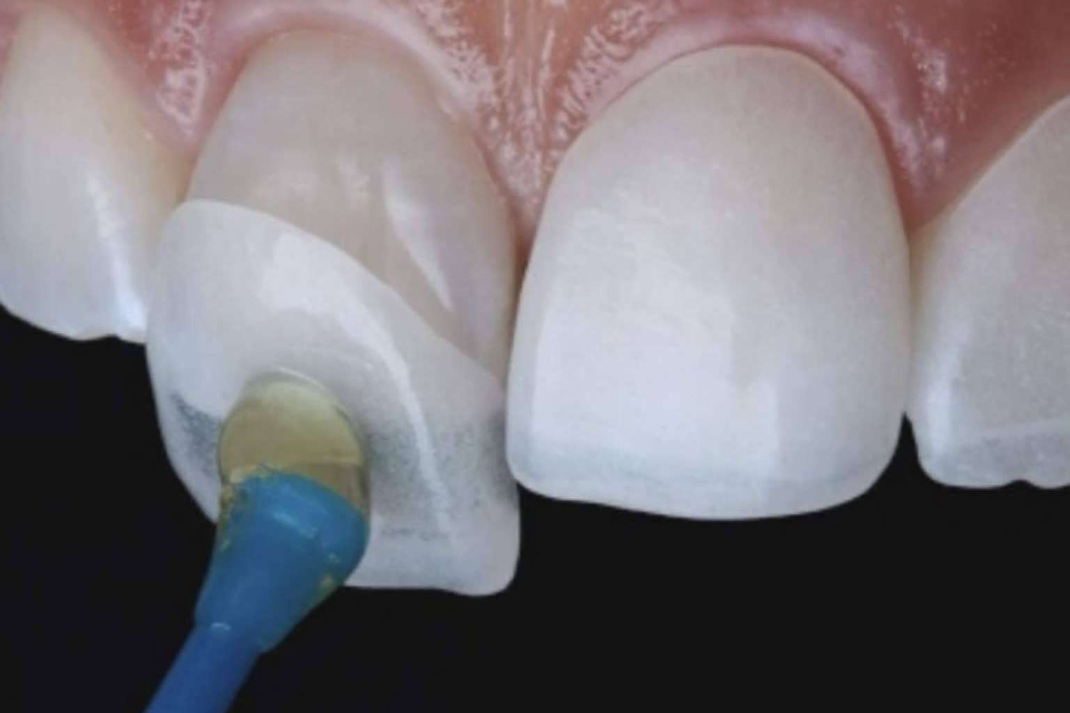 Todo sobre el tratamiento de carillas dentales en esta clínica dental de Chamartín