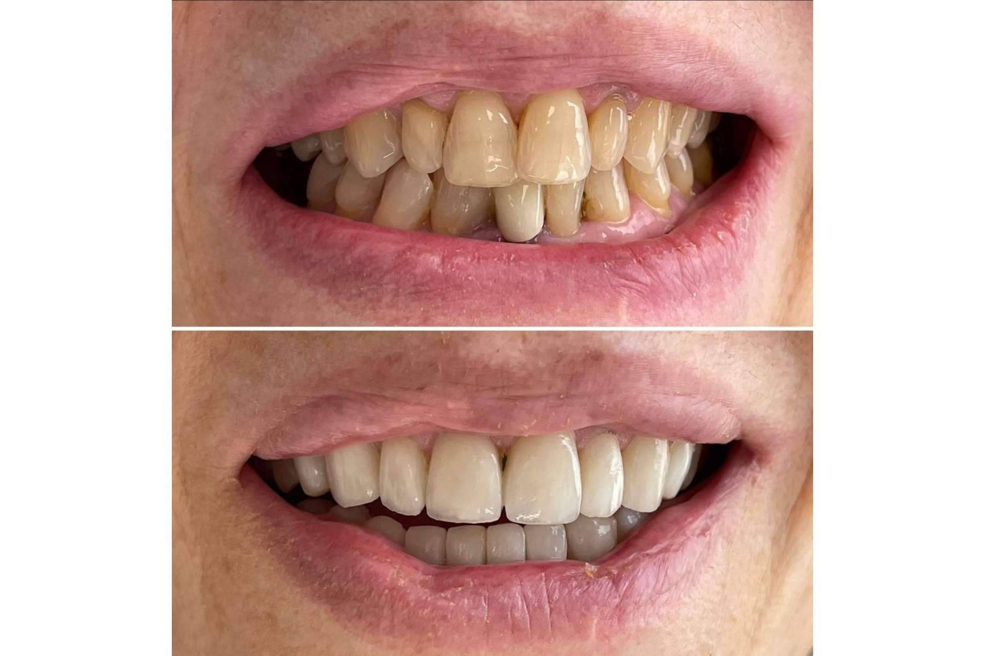 Todo lo que hay que saber sobre las microcarillas dentales, por la Clínica MG Dental & Estética Facial