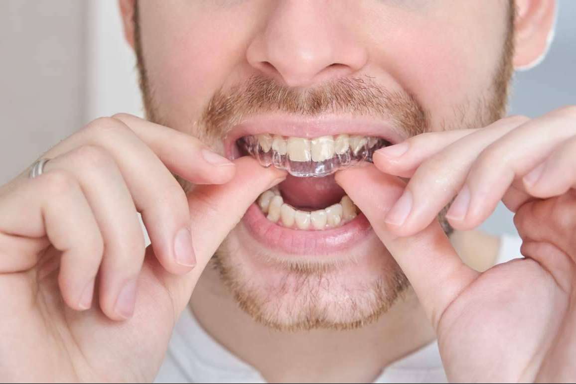 Clínicas Dental Bell habla sobre las ventajas de la ortodoncia invisible