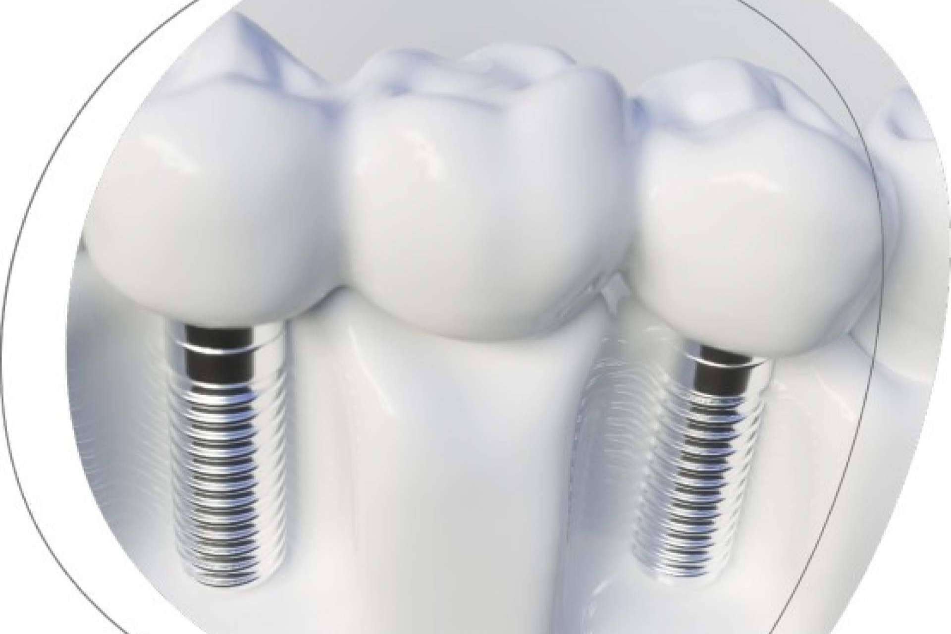 La Clínica Dental Agudo Rosa de Albacete cuenta con expertos en implantes dentales