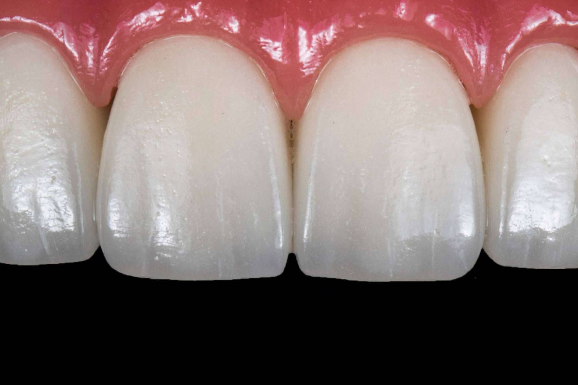 Corporación Dental realiza implantes de carga inmediata en Antequera