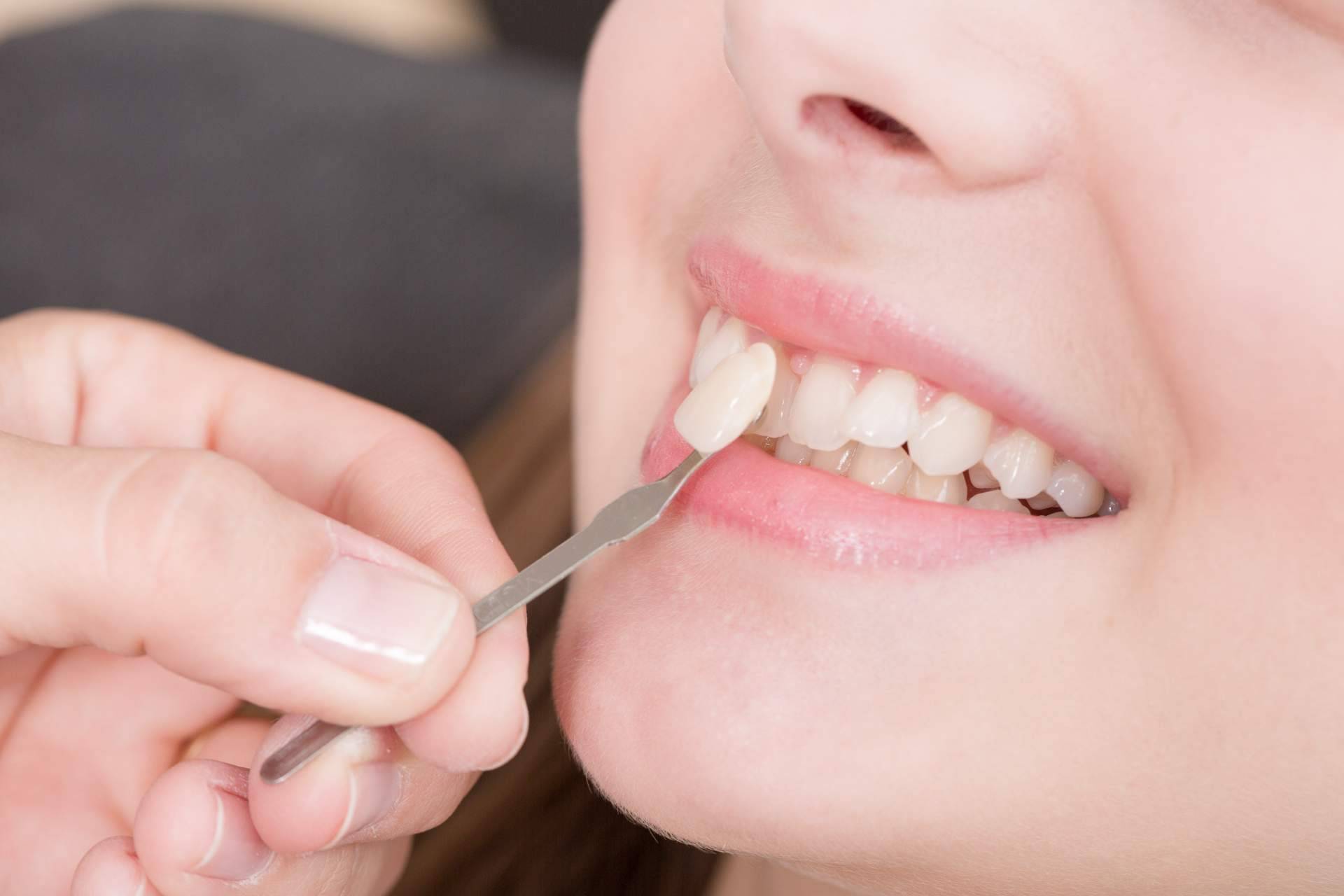 Las carillas dentales en Clínica Dental Delgado para mejorar la sonrisa de sus pacientes
