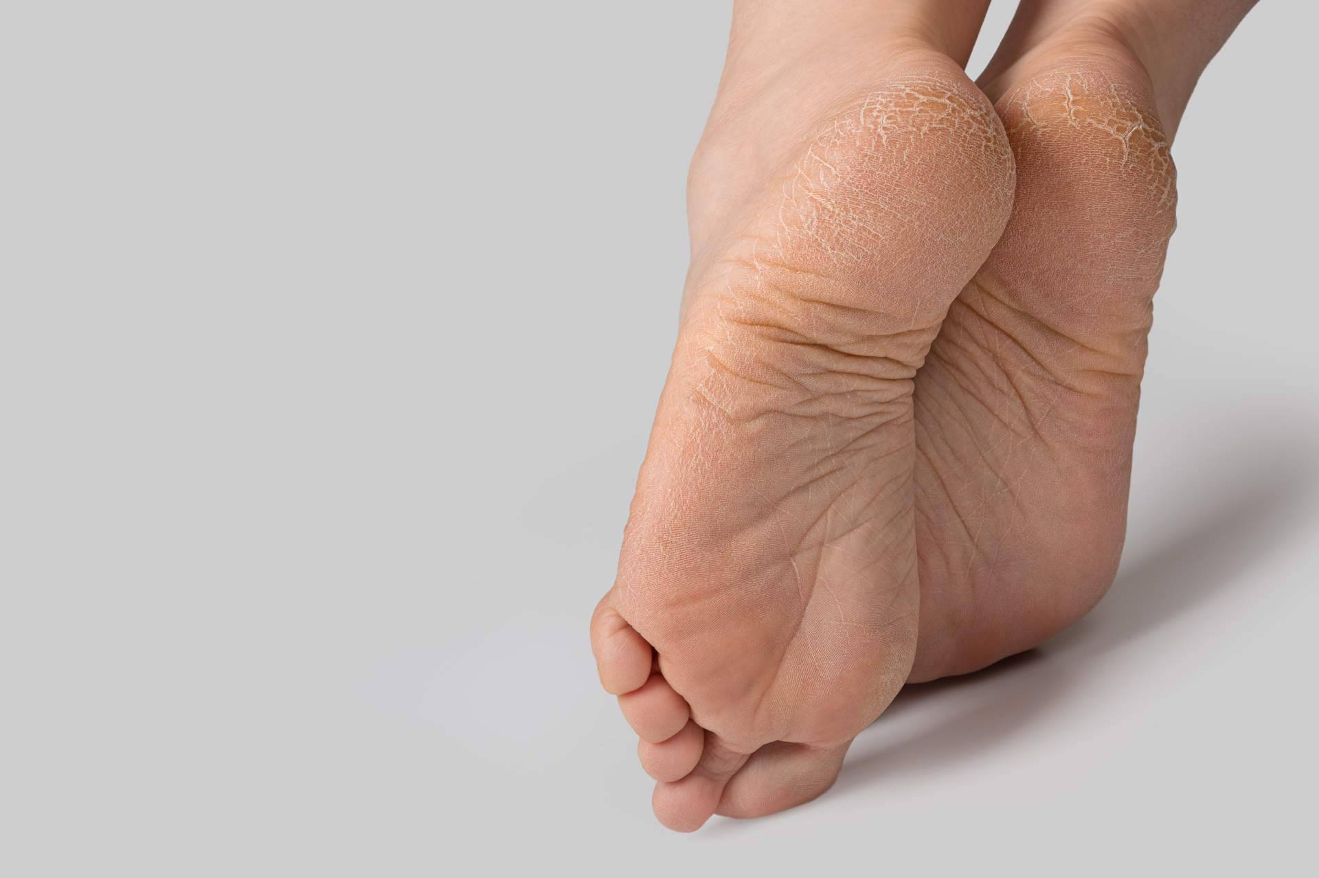 La relevancia de emplear plantillas a medida para las diferentes dolencias en el pie, Clínica de Podología Integral Pododerm