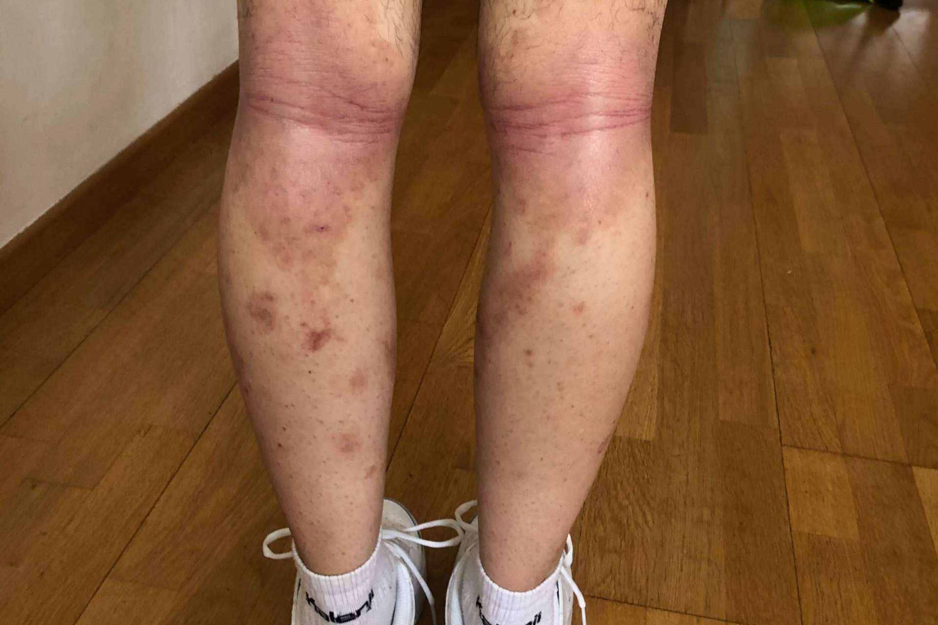 Tratando los problemas de la piel a través de la acupuntura y fototerapia, de la mano de Nüwa