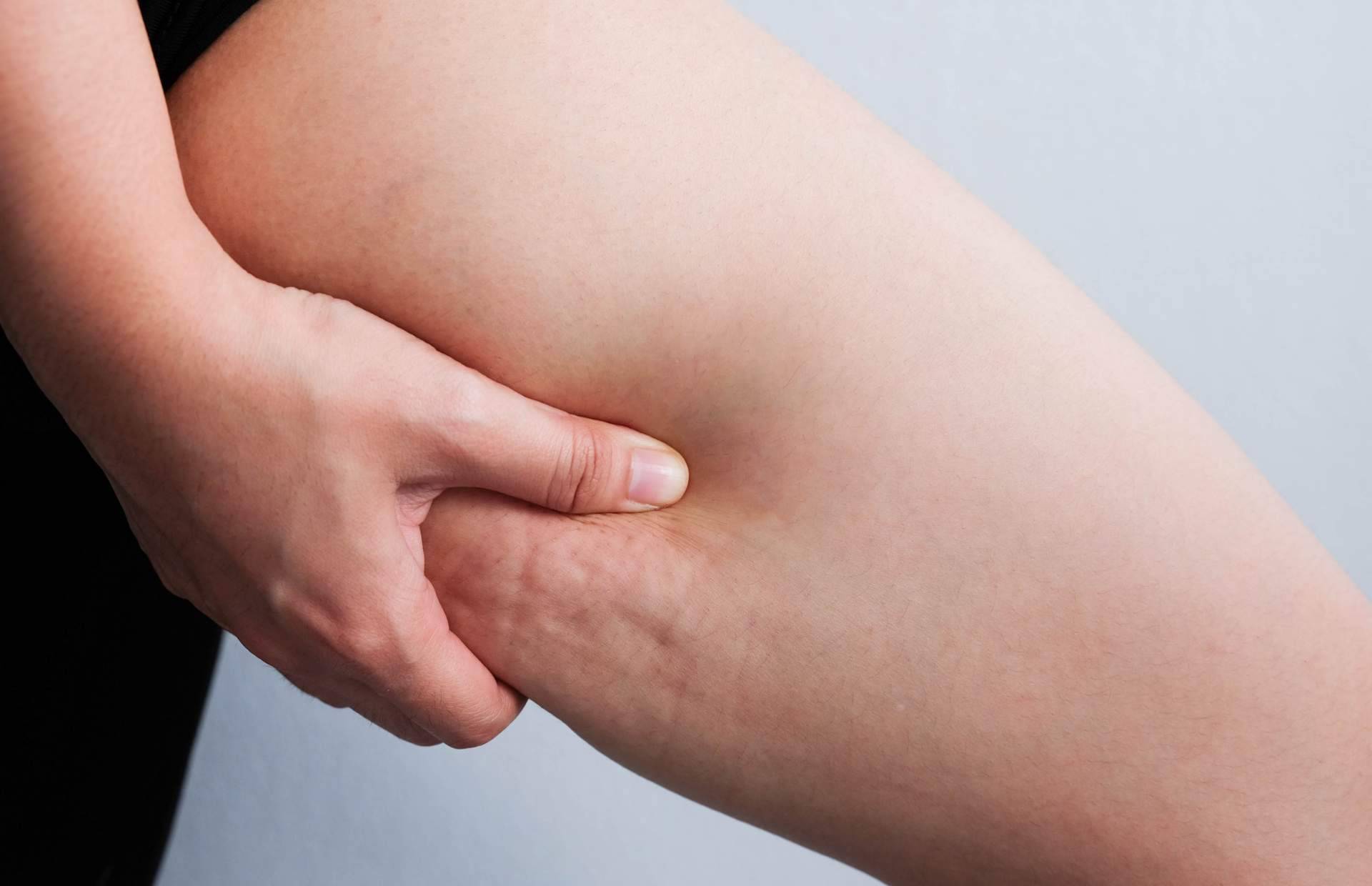 El tratamiento corporal para tratar y reducir la celulitis Vacuslim 48, ¿funciona realmente?