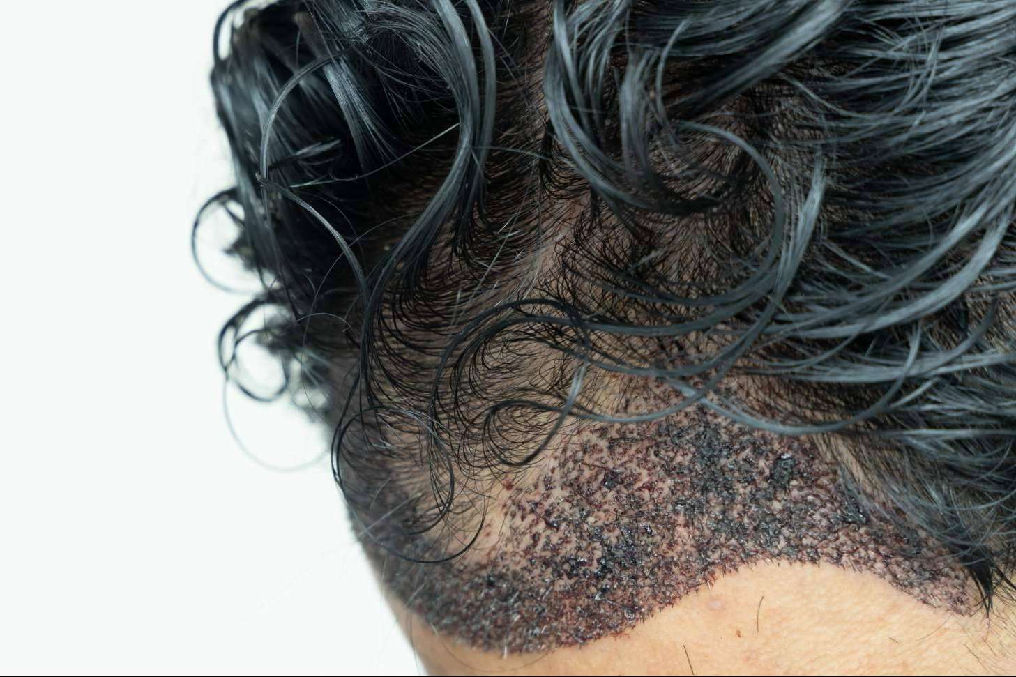 Microinjerto capilar para hombres en verano, en Capilar Innovation Clinic