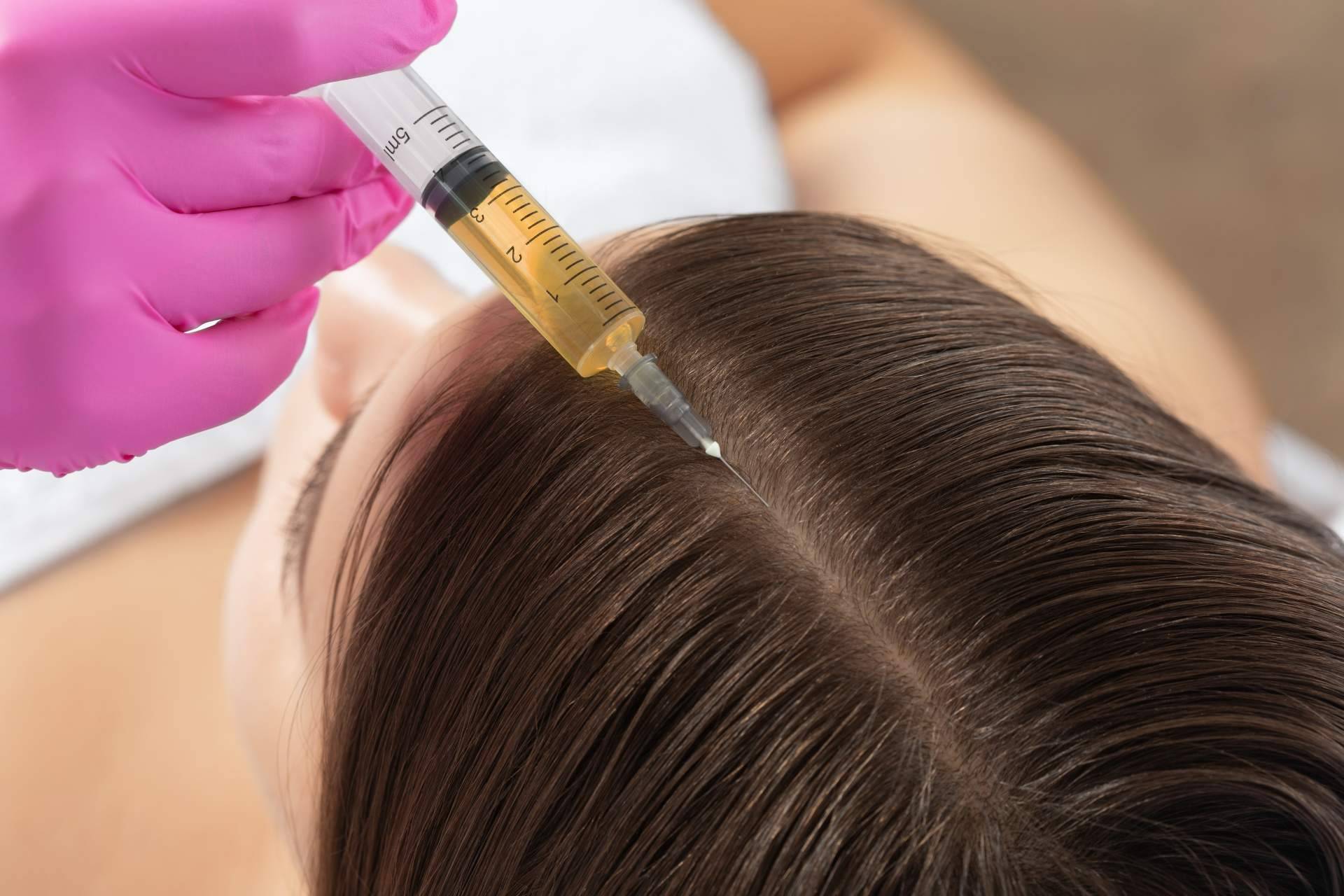 Recuperar la densidad capilar perdida con los tratamientos especializados para la alopecia difusa de MC360